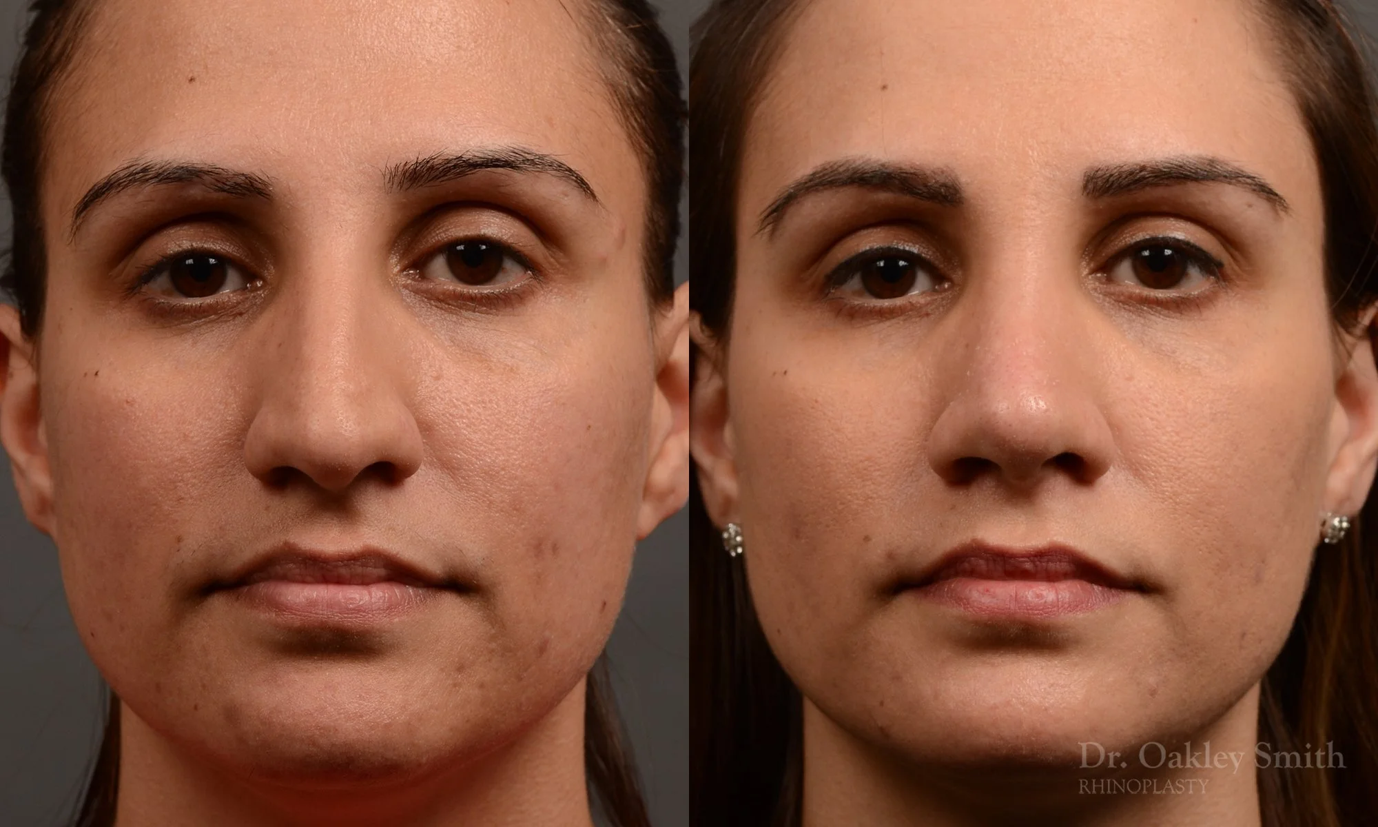 351A-rhinoplasty-dr-oakley-smith-toronto-nose-job.jpg