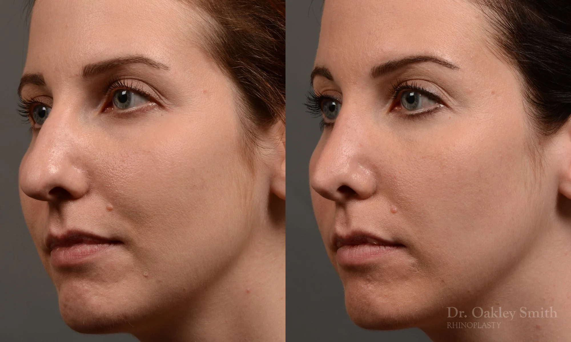 357D-rhinoplasty-dr-oakley-smith-toronto-nose-job - Copy.jpg