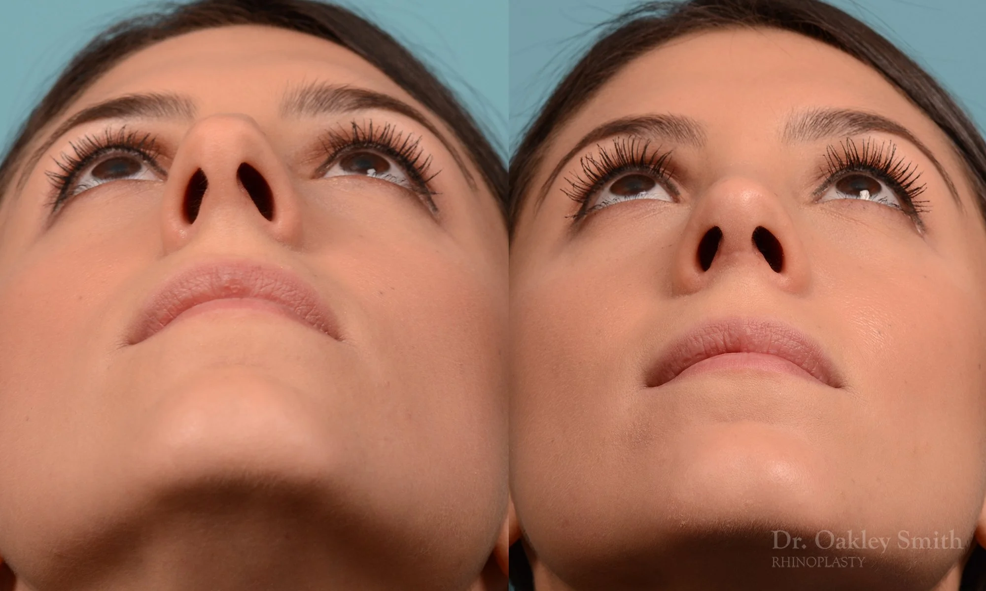 229F-rhinoplasty-oakley-smith-toronto-nose-job-straight-nose-bridge-1.jpg