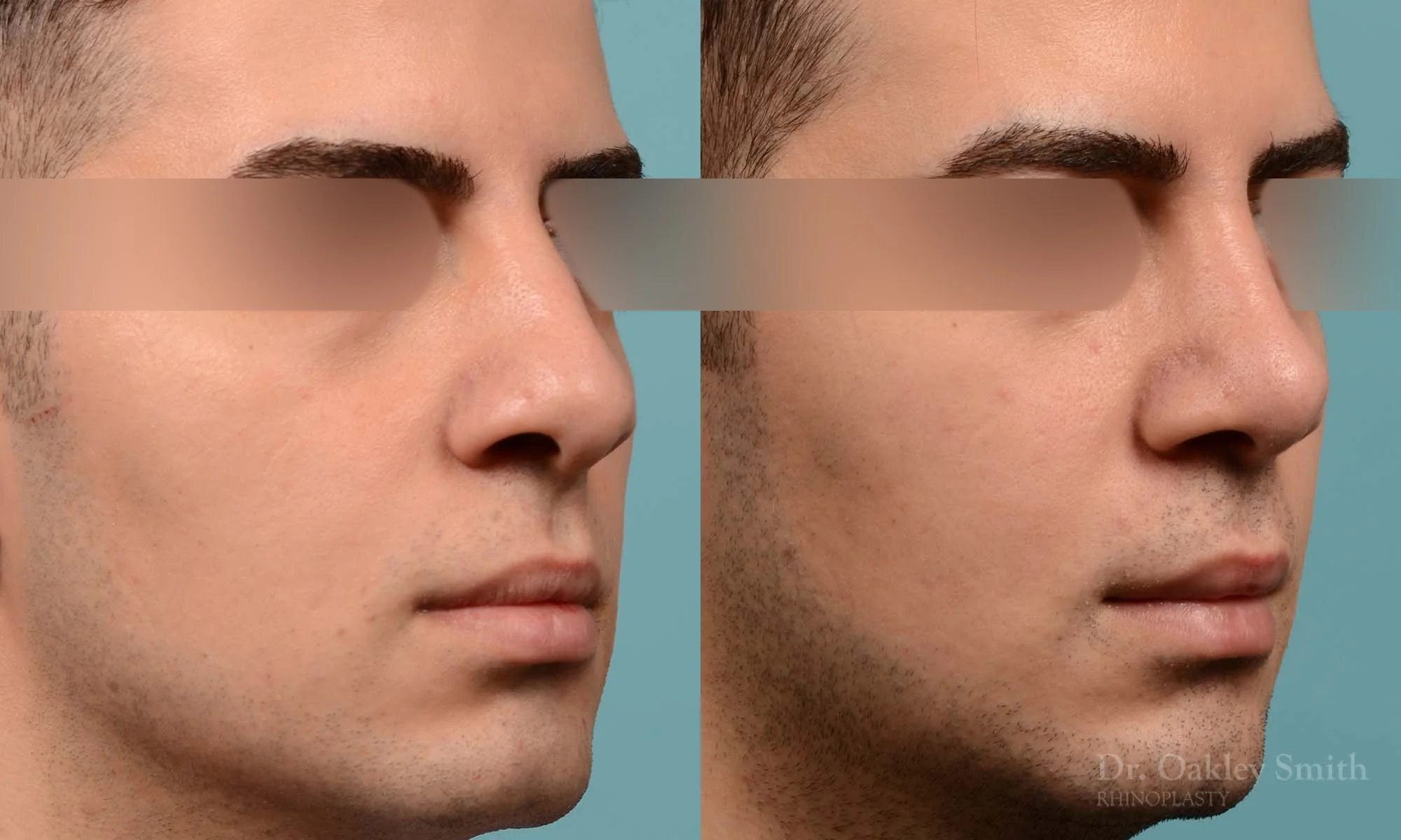 253B-rhinoplasty-dr-oakley-smith-toronto-male-nose-job.jpg