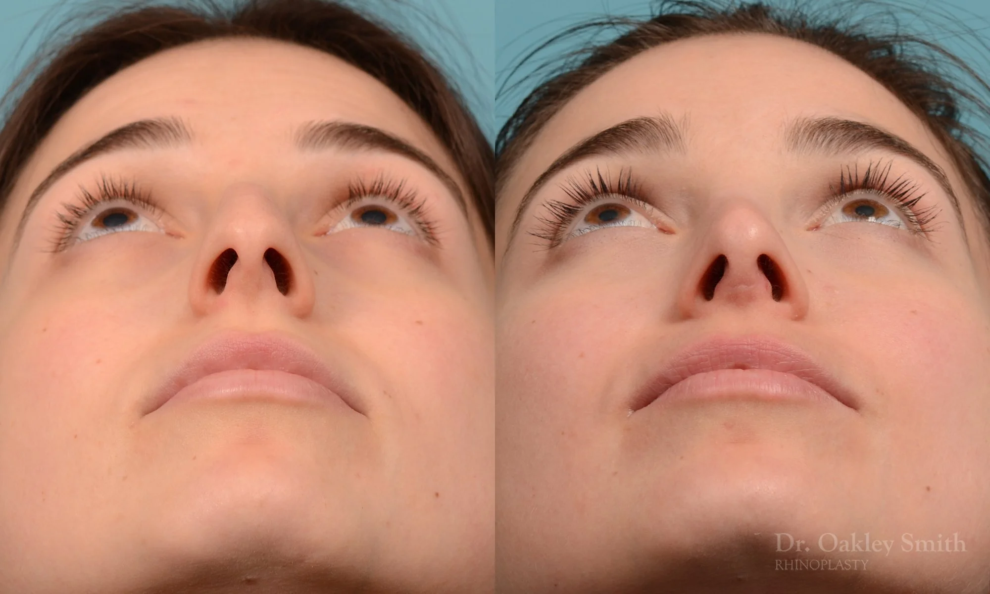 289F-rhinoplasty-dr-oakley-smith-toronto-nose-job.jpg