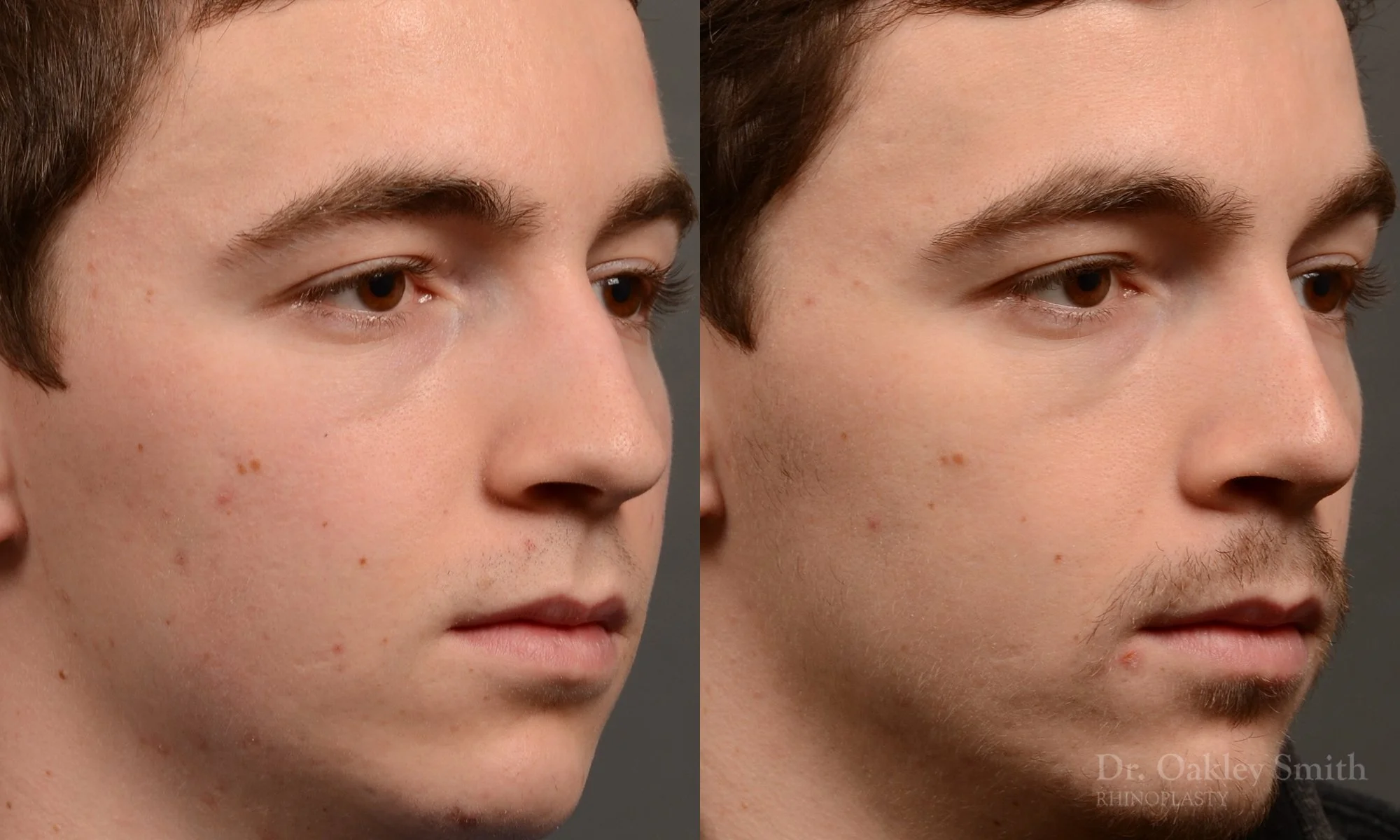 403B-male-rhinoplasty-dr-oakley-smith-toronto-nose-job.jpg