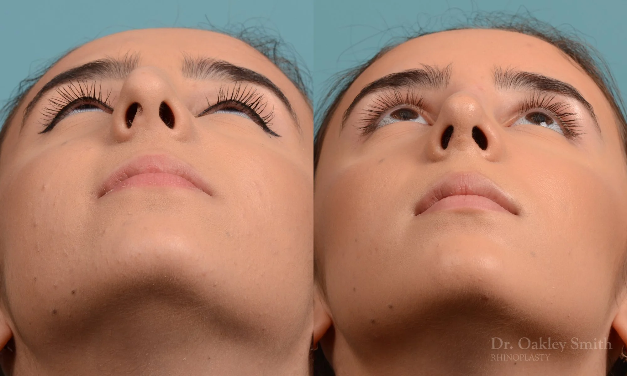 301F-rhinoplasty-dr-oakley-smith-toronto-nose-job.jpg