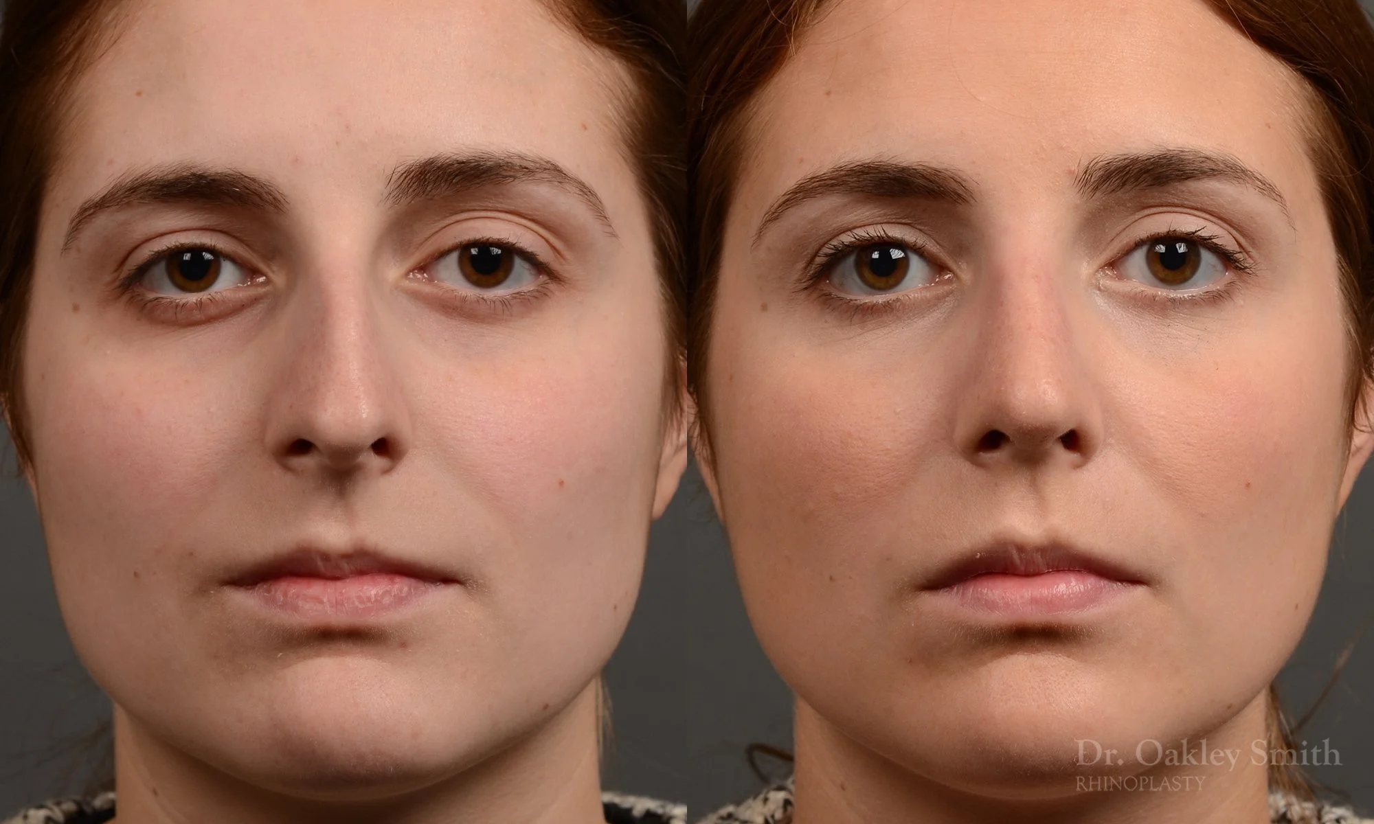 305A-rhinoplasty-dr-oakley-smith-toronto-nose-job.jpg