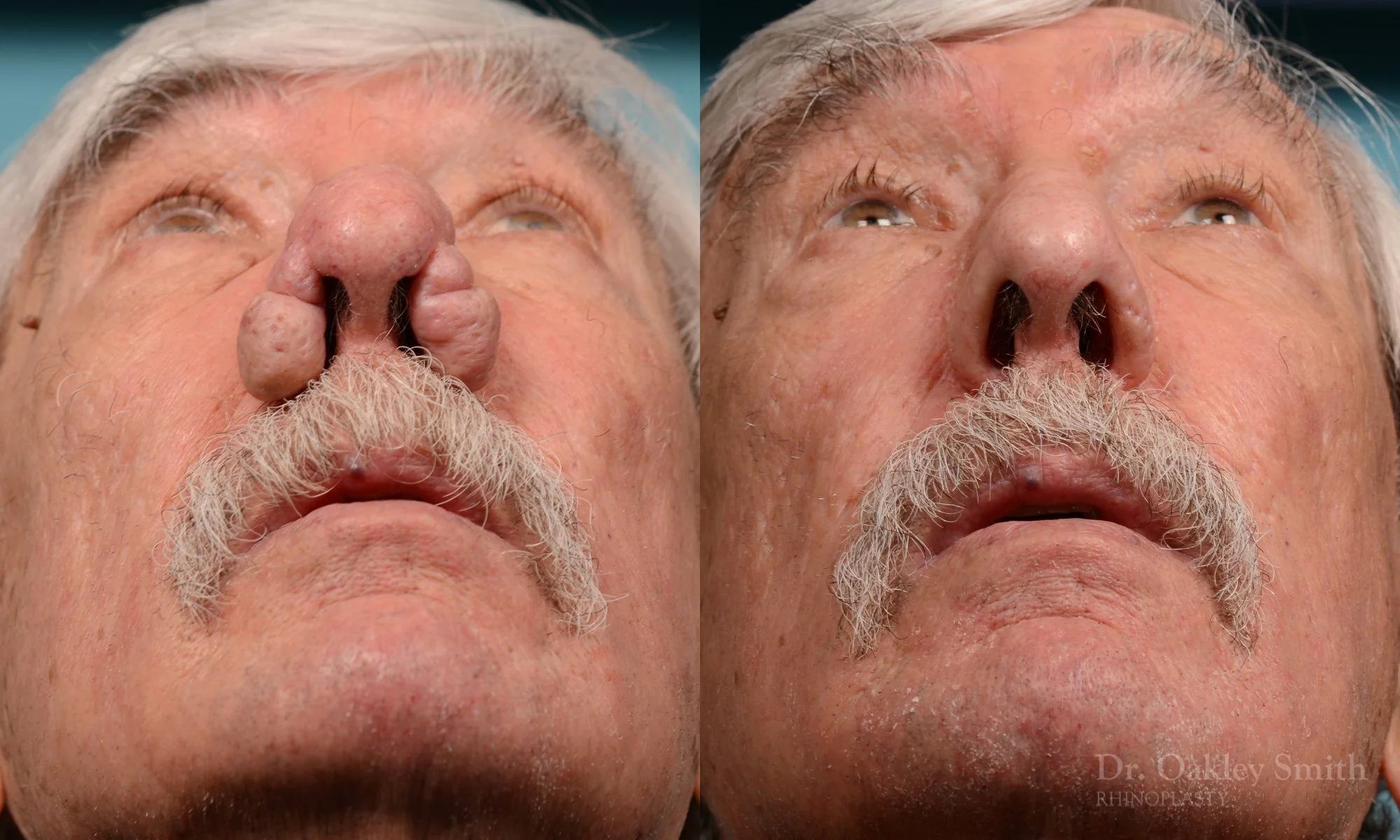 227F-rhinophyma-rhinoplasty-dr-oakley-smith-toronto-nose-job-1.jpg