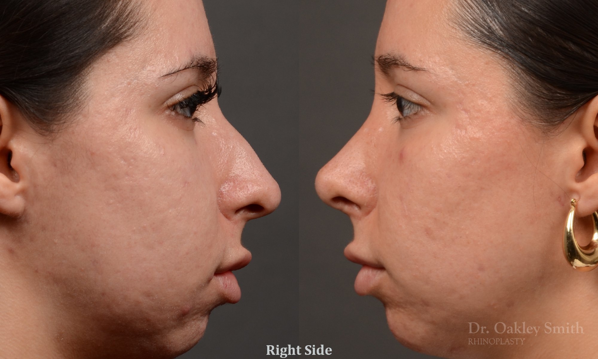486C-rhinoplasty-dr-oakley-smith-toronto-top-surgeon-nose-job.jpg
