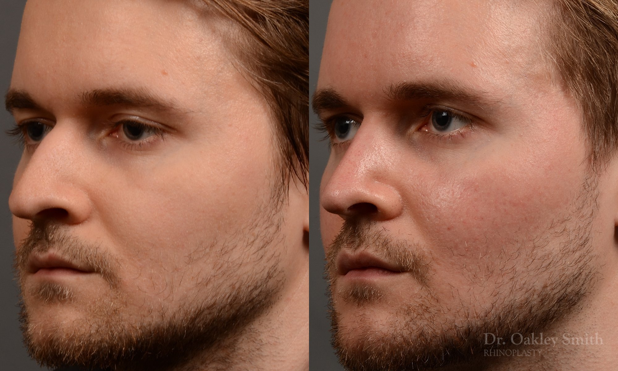 401D-expert-rhinoplasty-surgeon-rhinoplasty-dr-oakley-smith-toronto-nose-job-surgery.jpg