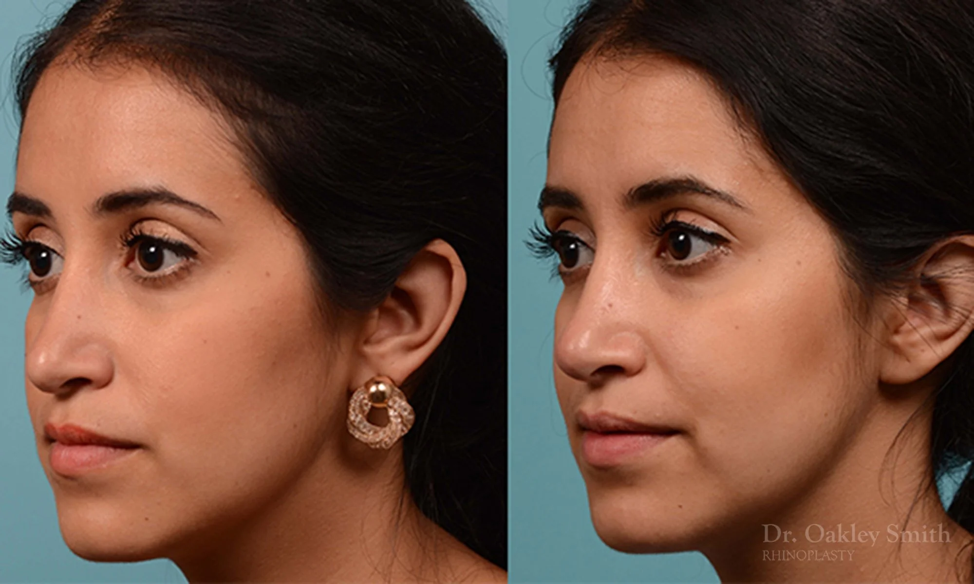 226D-rhinoplasty-dr-oakley-smith-toronto-nose-job-1.jpg
