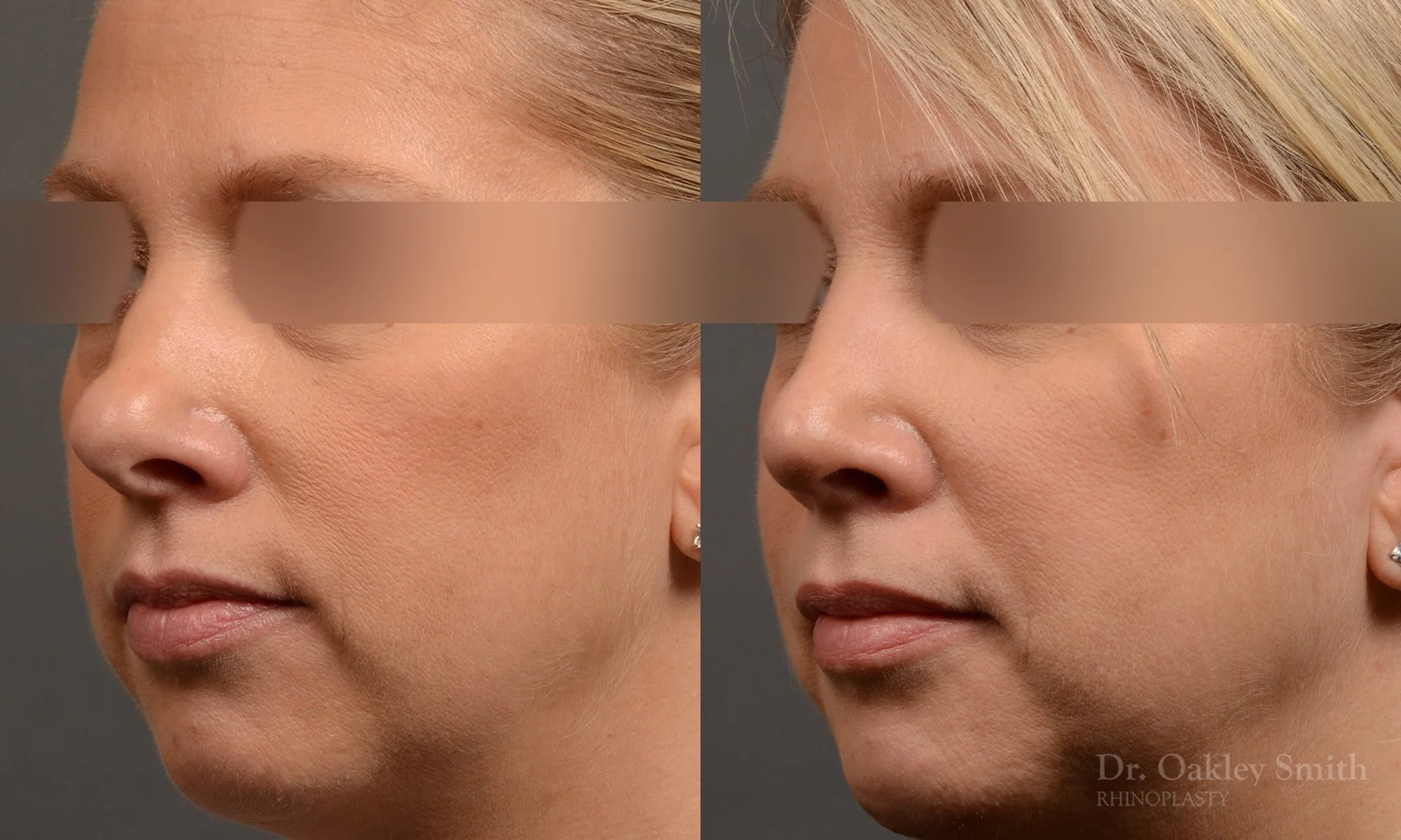 344D-rhinoplasty-dr-oakley-smith-toronto-nose-job-1.jpg