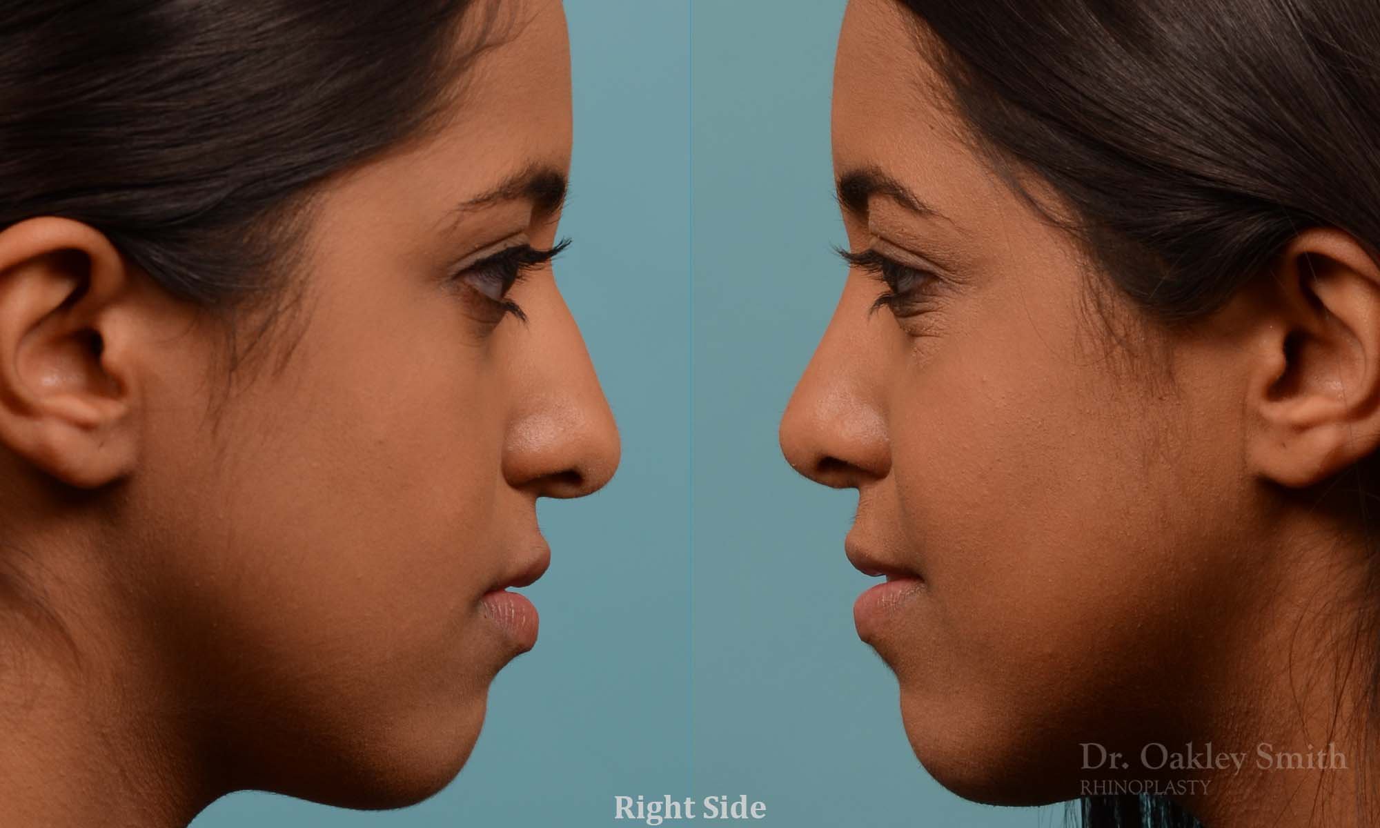 285C-rhinoplasty-dr-oakley-smith-toronto-nose-job.jpg