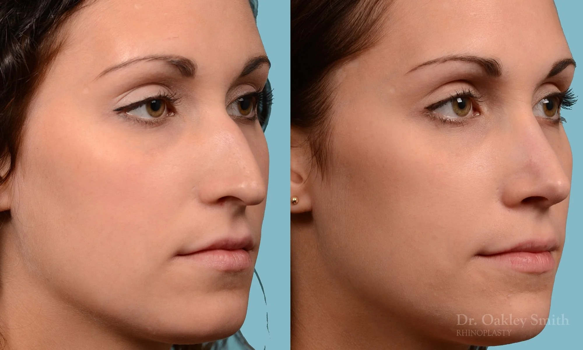 224B-rhinoplasty-nose-job-dr-oakley-smith-toronto-long-nose-large-nose-straight-nose-bridge-1.jpg