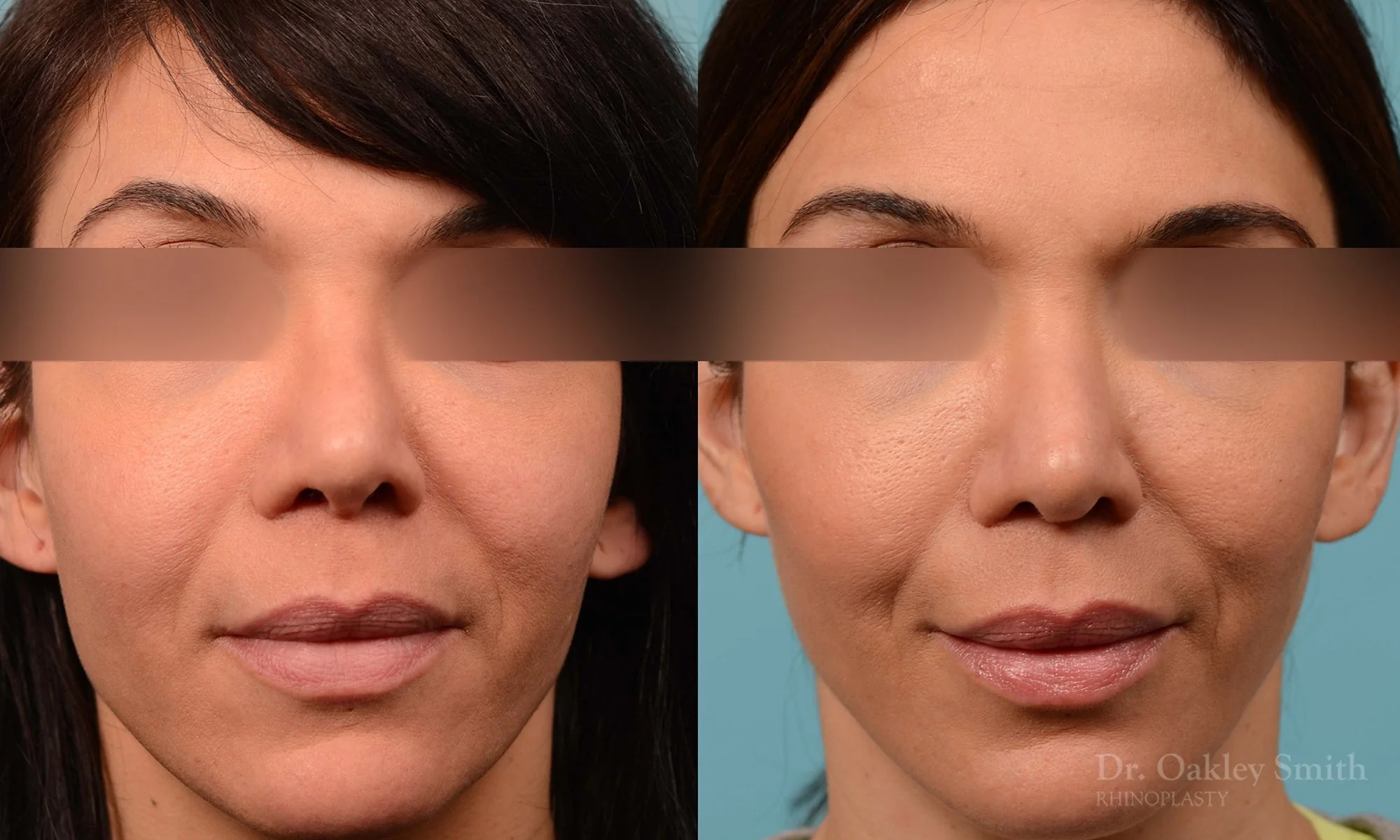 219A-rhinoplasty-toronto-dr-oakley-smith-curved-bridge-raised-tip-rotation-big-nose-nose-job-1.jpg