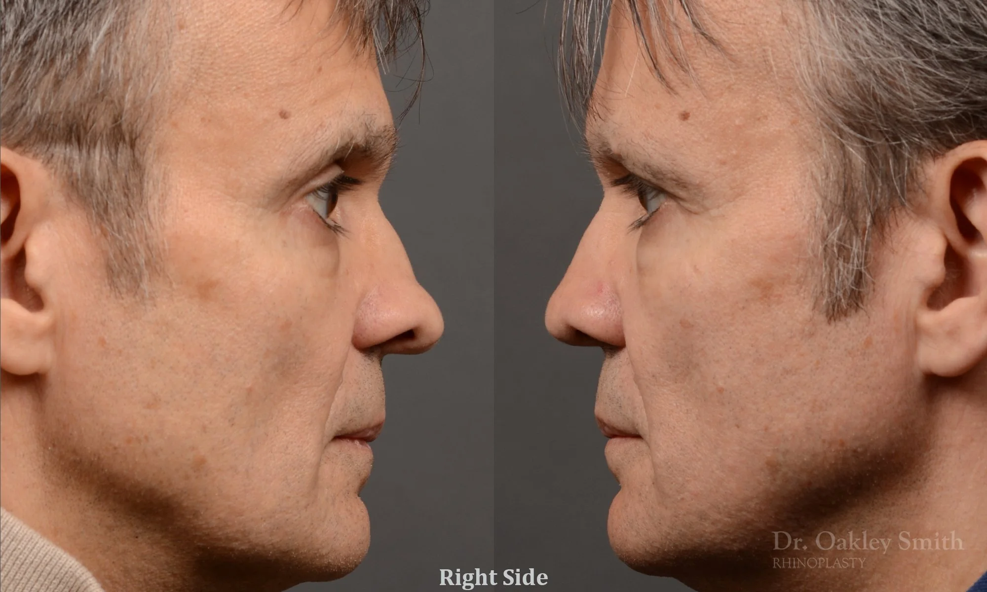 306.1C-rhinoplasty-dr-oakley-smith-toronto-nose-job.jpg