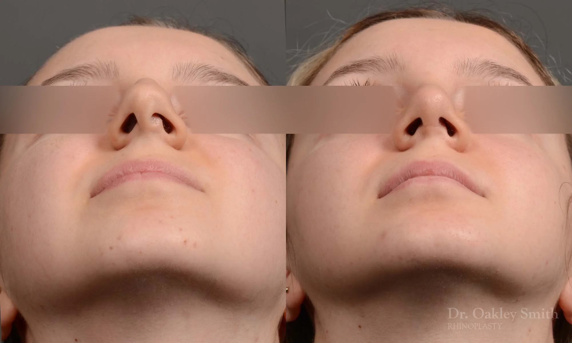 326F-rhinoplasty-dr-oakley-smith-toronto-nose-job.jpg