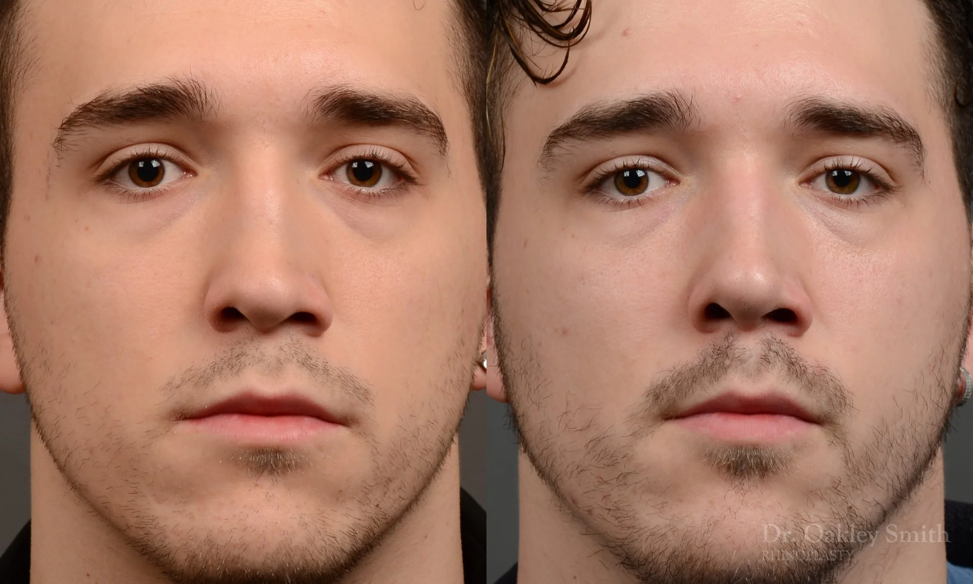 503A-male-rhinoplasty-dr-oakley-smith-toronto-top-surgeon-nose-job.jpg