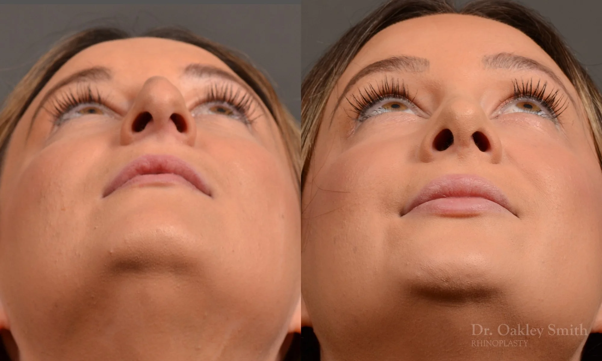 478F-rhinoplasty-dr-oakley-smith-toronto-top-surgeon-nose-job.jpg
