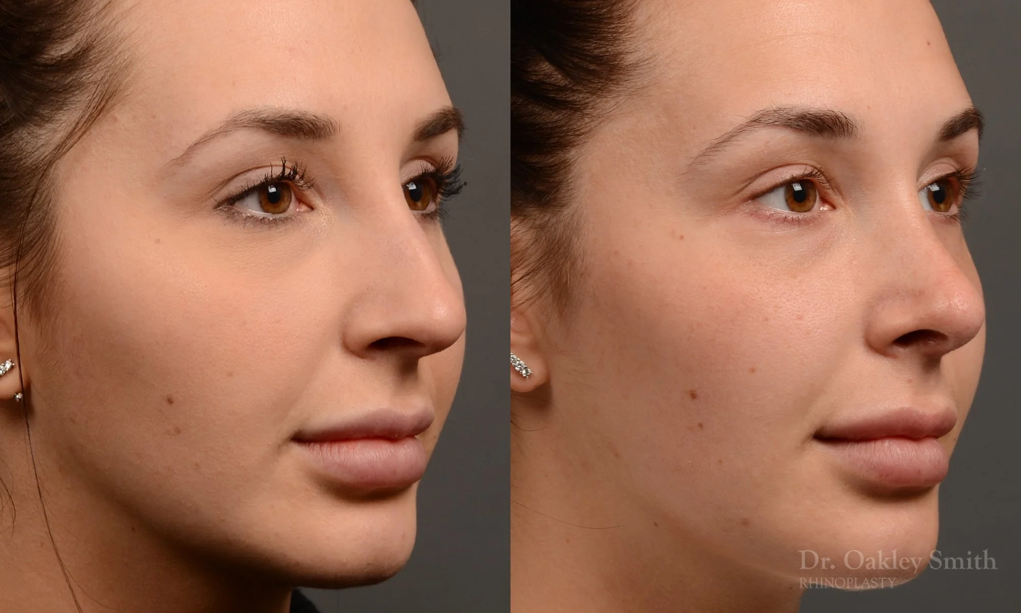 294B-rhinoplasty-dr-oakley-smith-toronto-nose-job.jpg