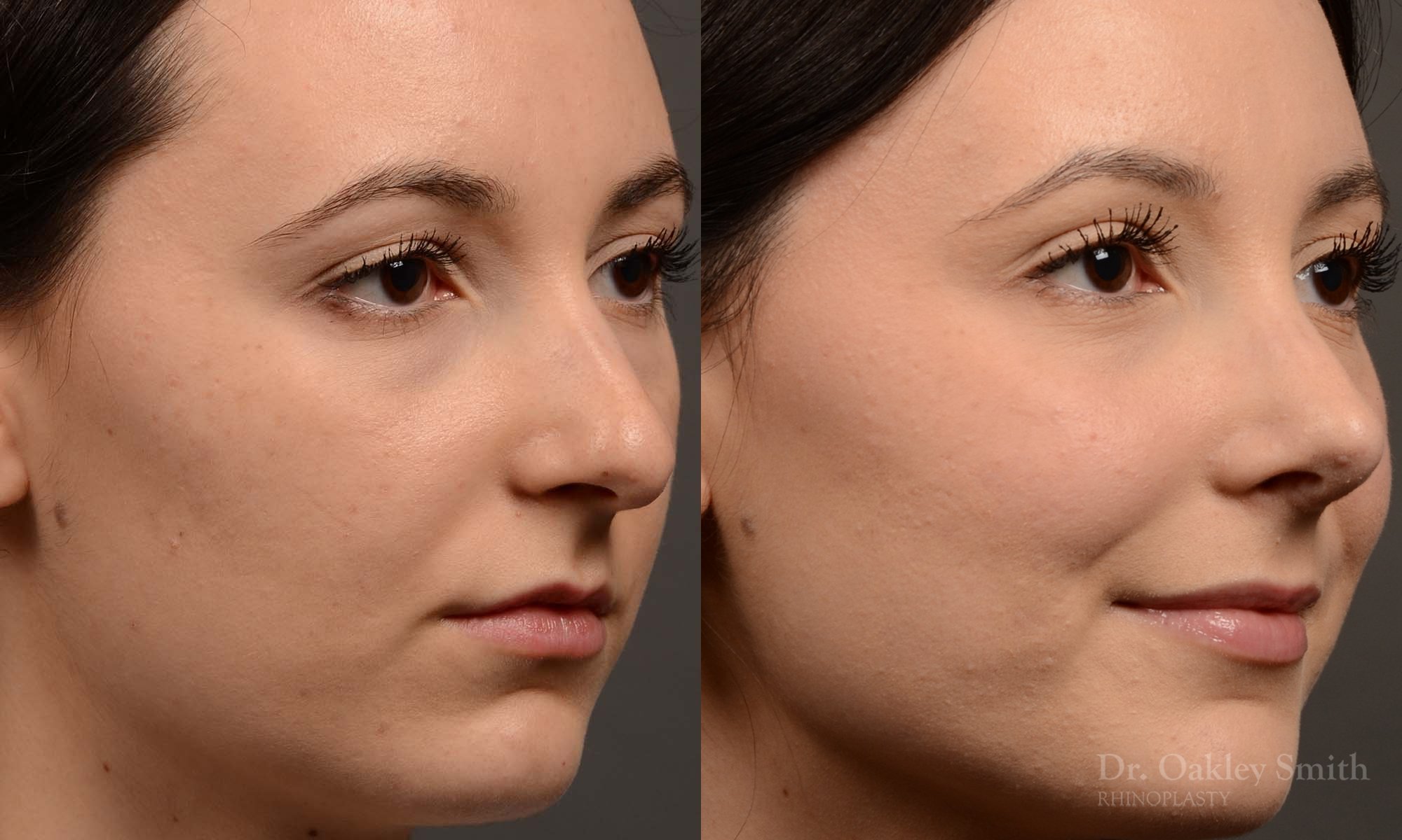 449.1B-revision-rhinoplasty-dr-oakley-smith-toronto-top-surgeon-nose-job.jpg