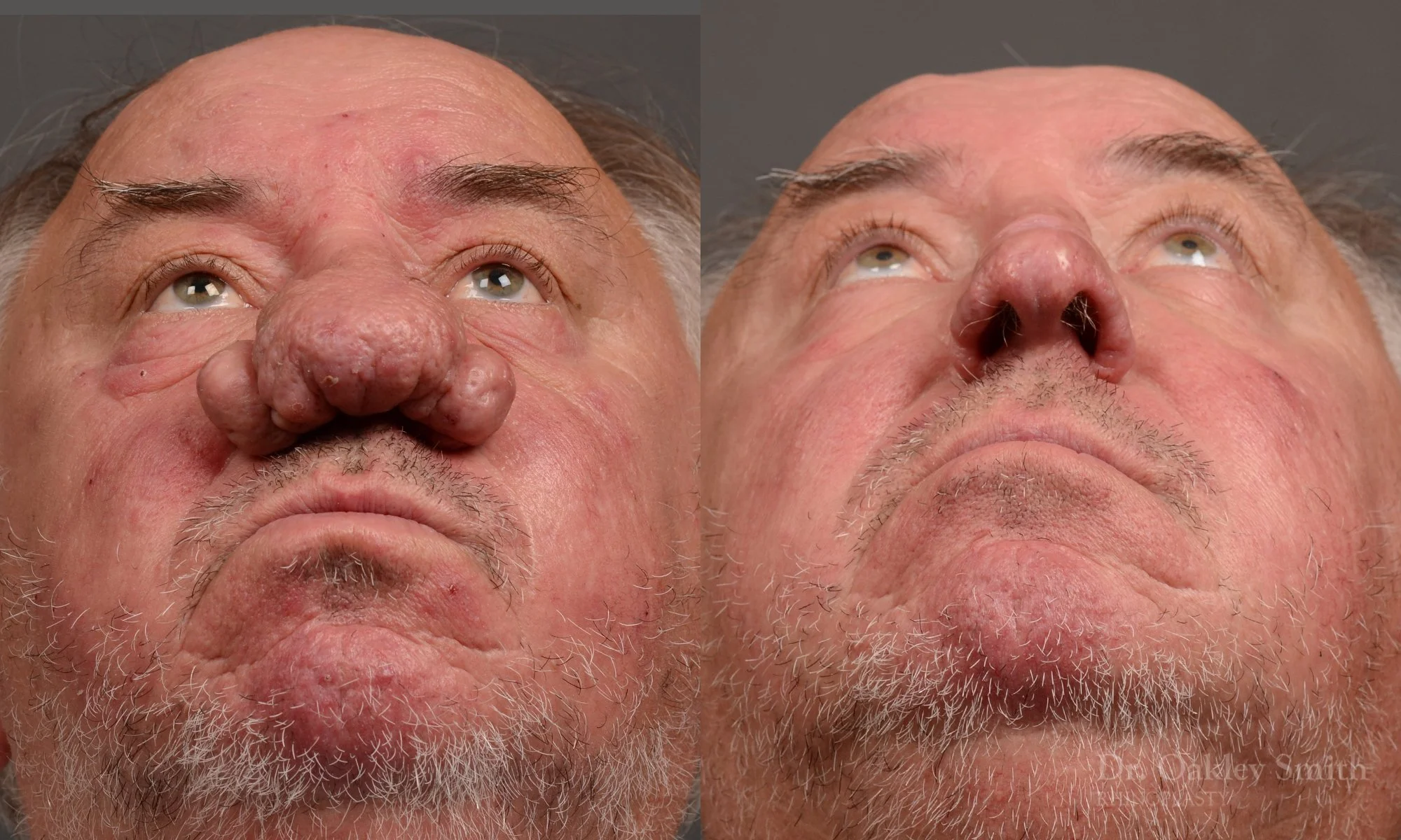 471F-rhinoplasty-septoplastry-dr-oakley-smith-toronto-top-surgeon-nose-job.jpg
