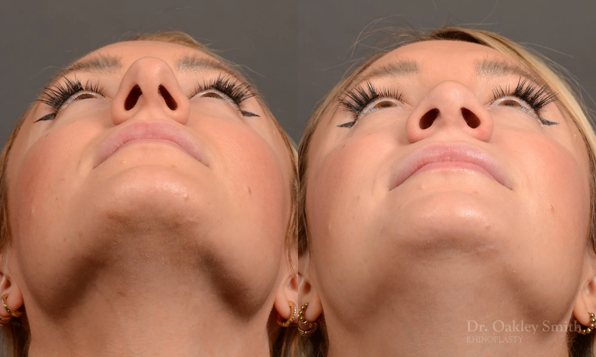 550F-rhinoplasty-nose-job-toronto-nose-surgeon-dr-oakley-smith.jpg
