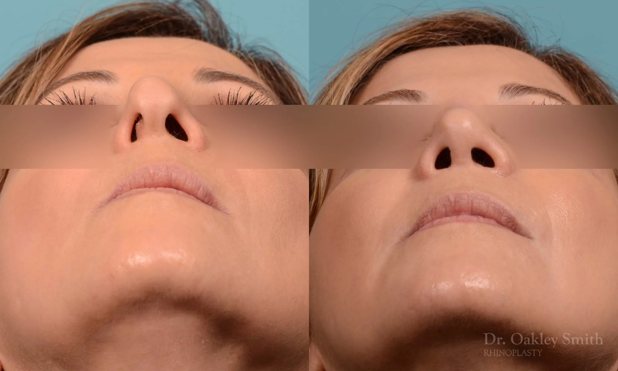 244F-rhinoplasty-dr-oakely-smith-septum.jpg