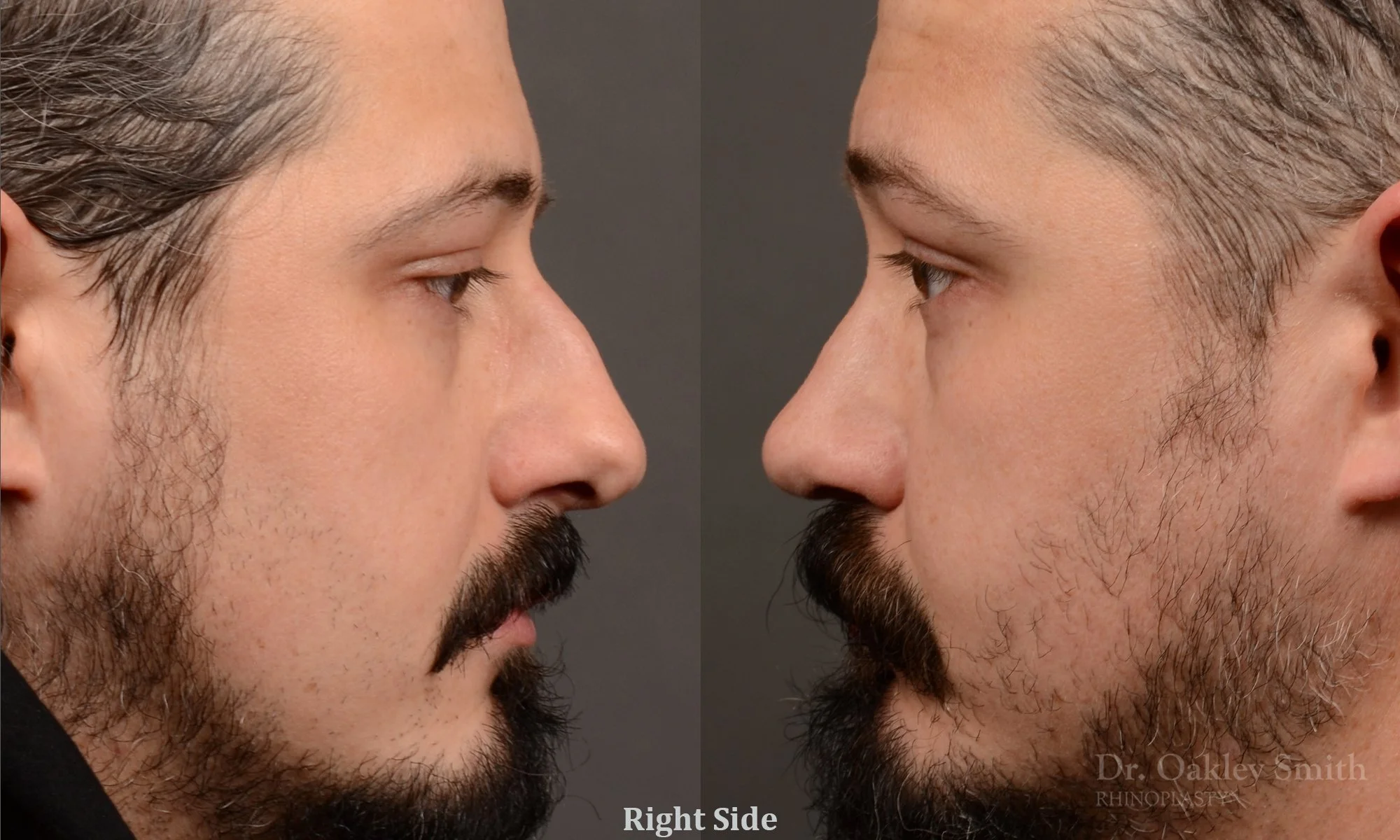 501C-male-rhinoplasty-dr-oakley-smith-toronto-top-surgeon-nose-job.jpg