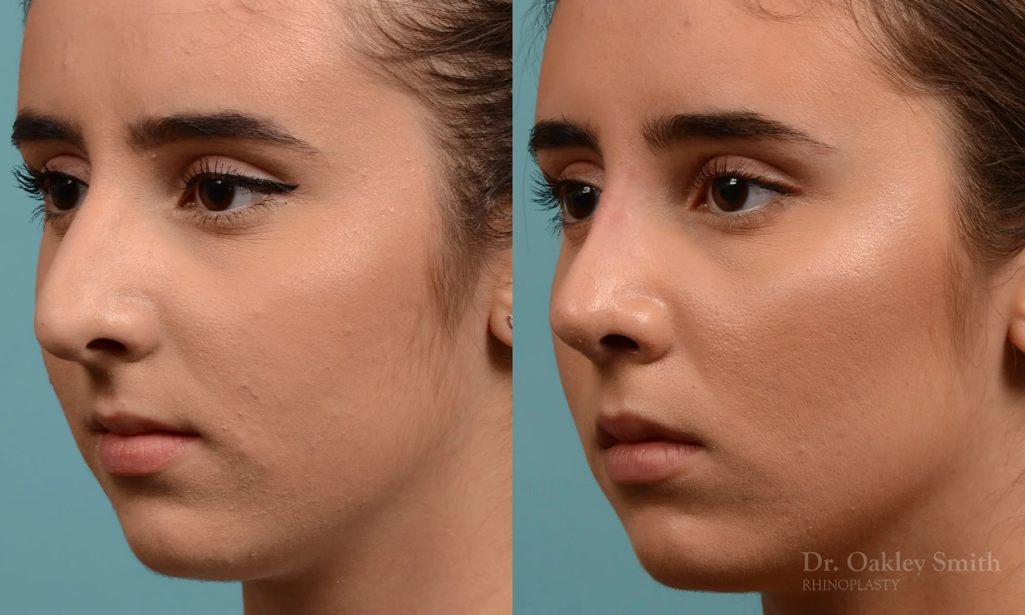 301D-rhinoplasty-dr-oakley-smith-toronto-nose-job (1).jpg