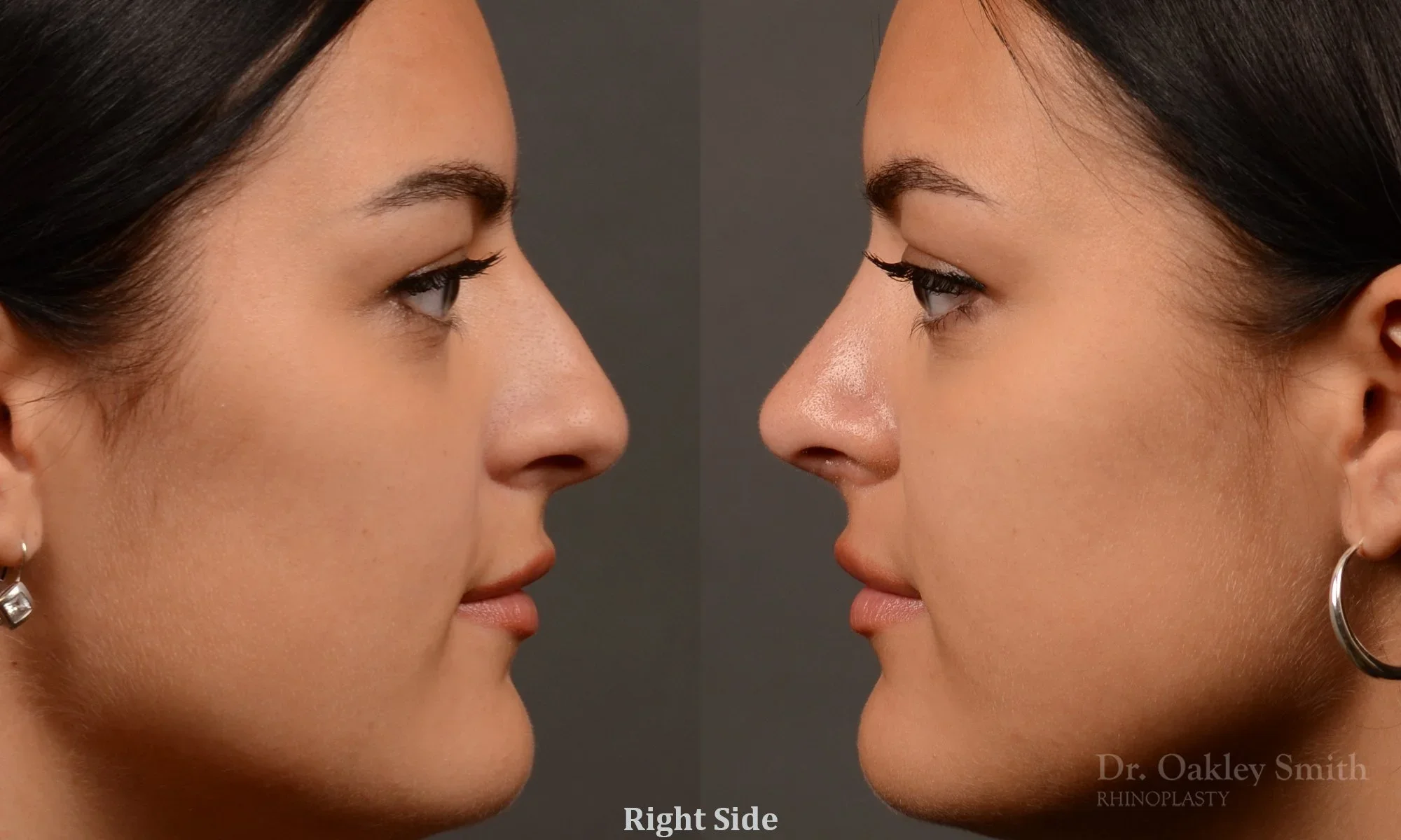 496: Female, Ethnic Rhinoplasty, Thick Skin, Wide Bridge and Tip