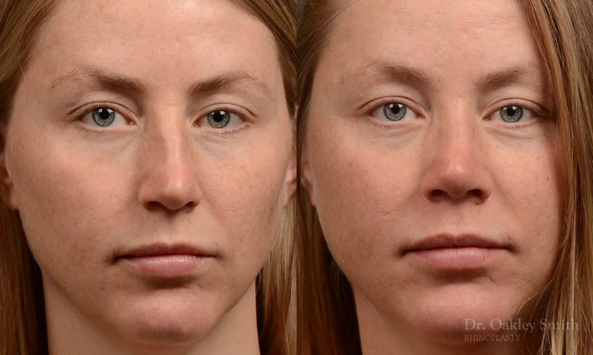 482A-rhinoplasty-dr-oakley-smith-toronto-top-surgeon-nose-job-1.jpg