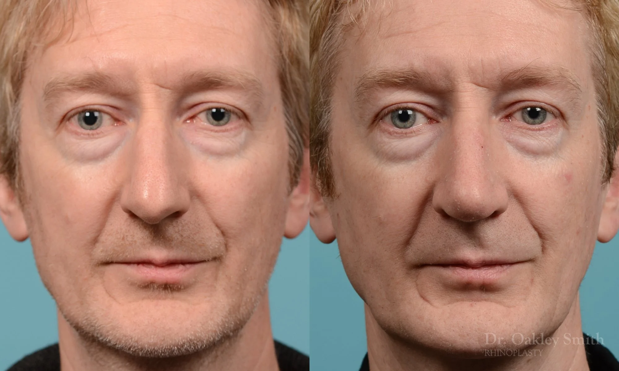 276A-rhinoplasty-dr-oakley-smith-toronot-nose-job.jpg