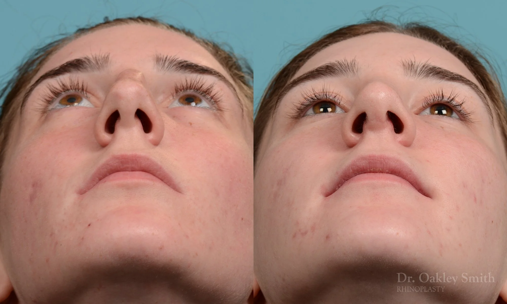 248F-rhinoplasty-dr-oakley-smith-toronto-nose-job.jpg