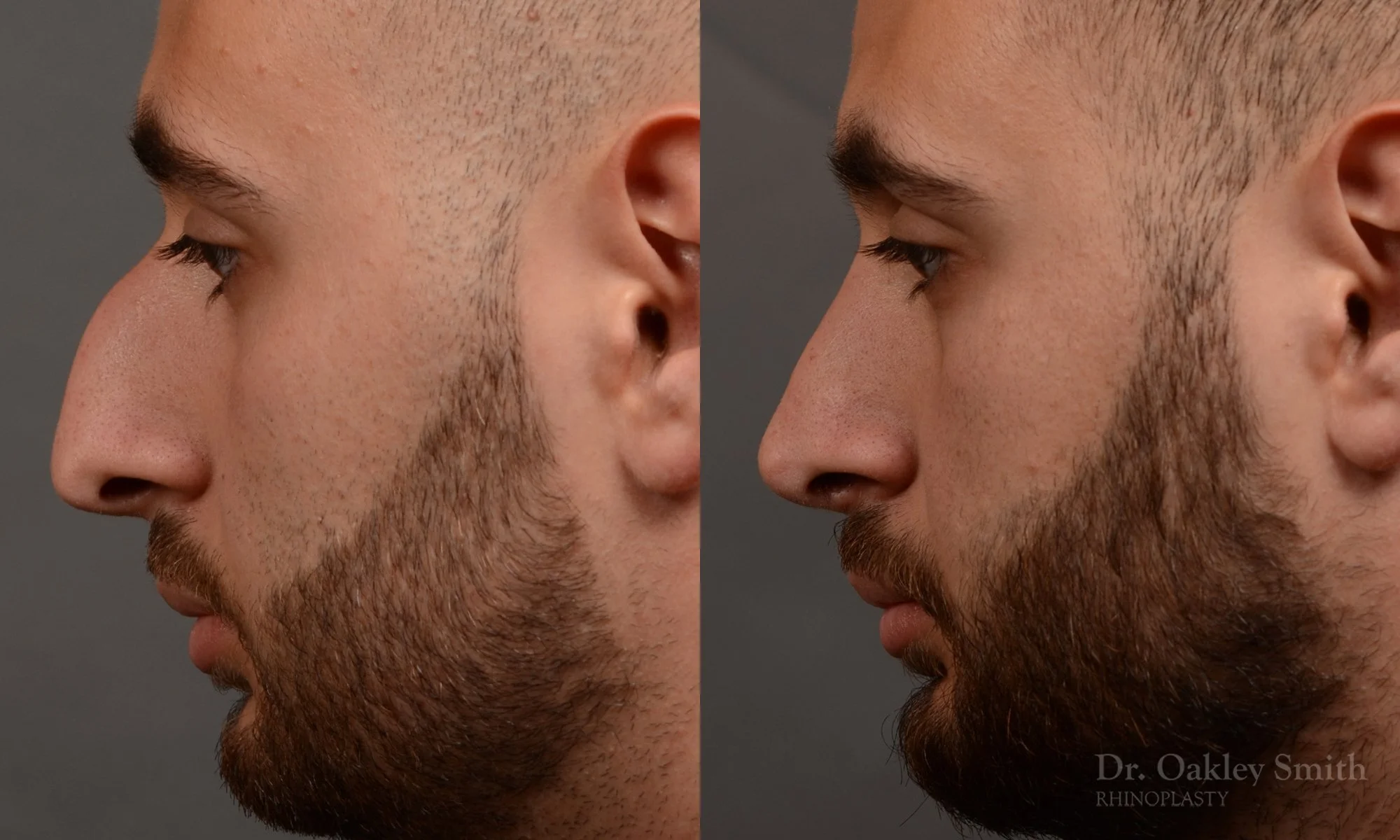 391E-rhinoplasty-dr-oakley-smith-toronto-nose-job.jpg