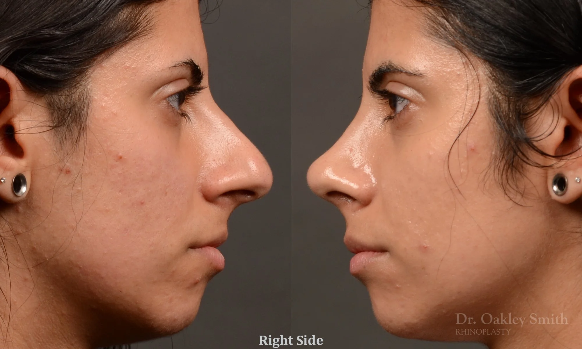 518: Female, Ethnic Rhinoplasty, Thick Skin, Dorsal Hump, Tip Work, Crooked