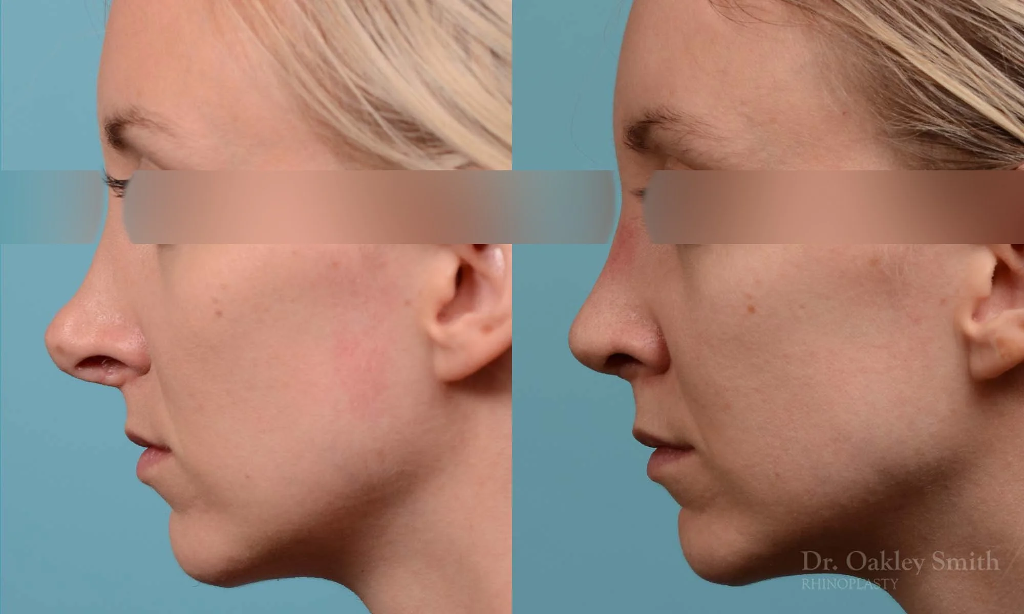 280E-rhinoplasty-dr-oakley-smith-toronto-nose-job.jpg