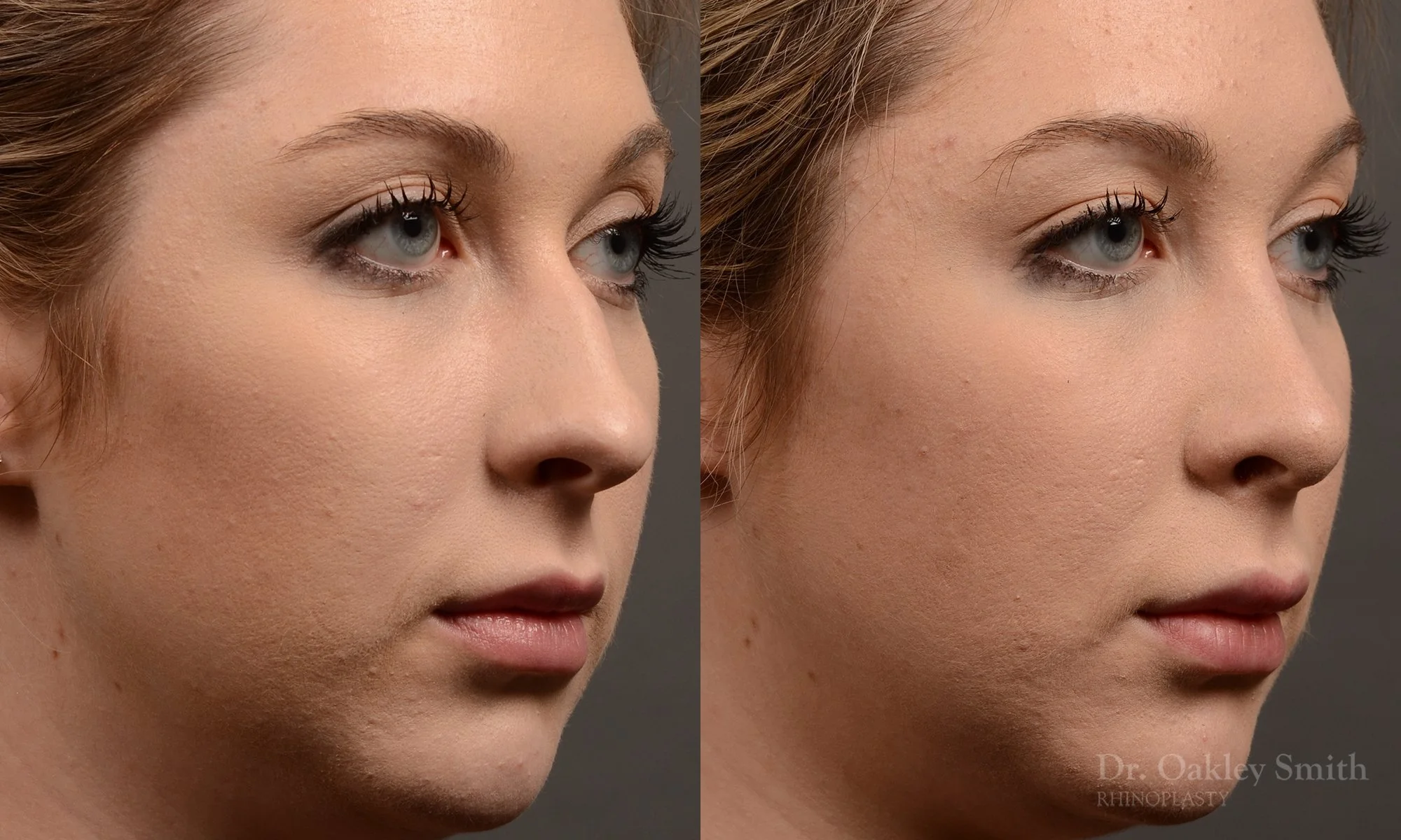 348B-rhinoplasty-dr-oakley-smith-toronto-nose-job.jpg