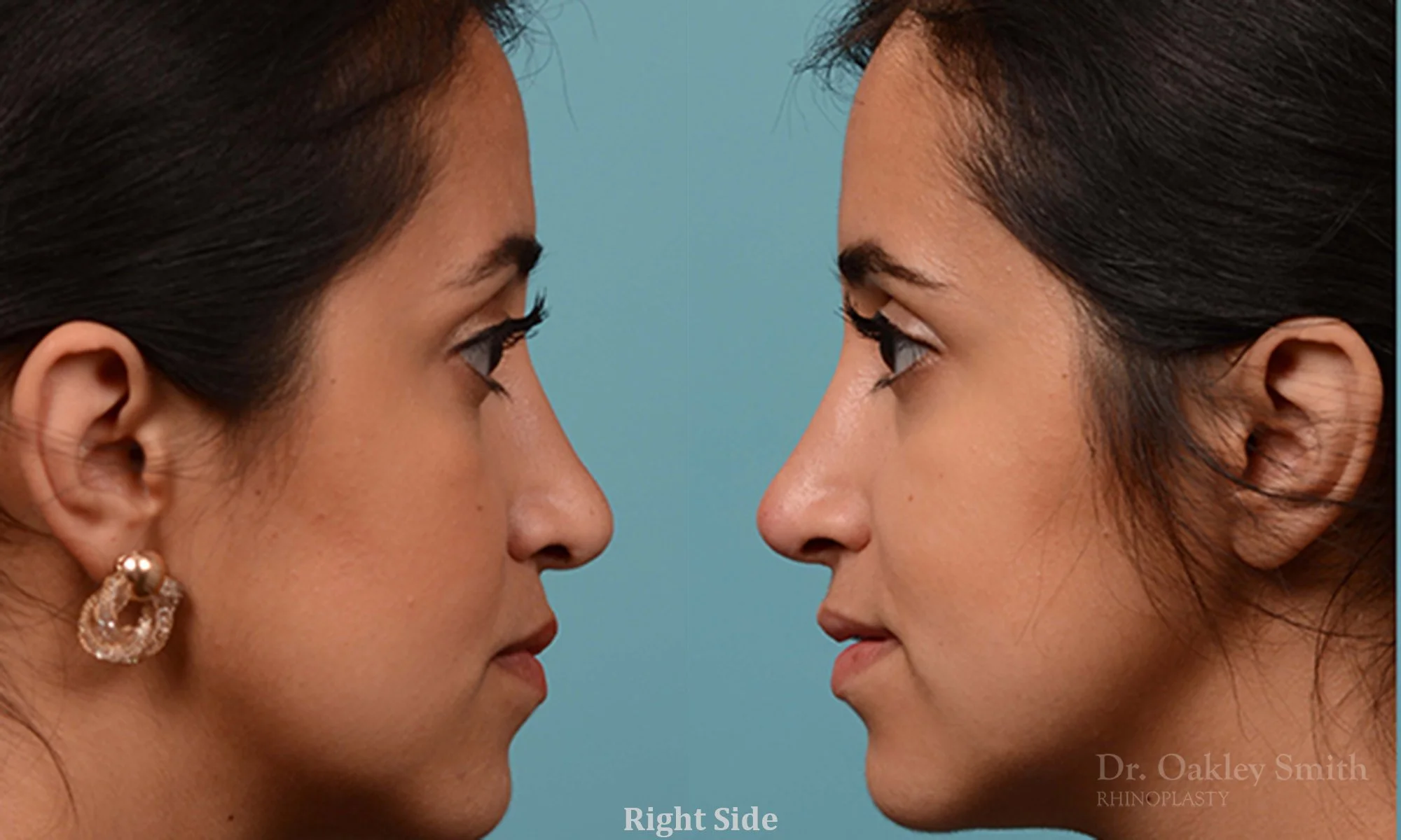 226: Female, Revision Rhinoplasty, Tip Bridge Reconstruction