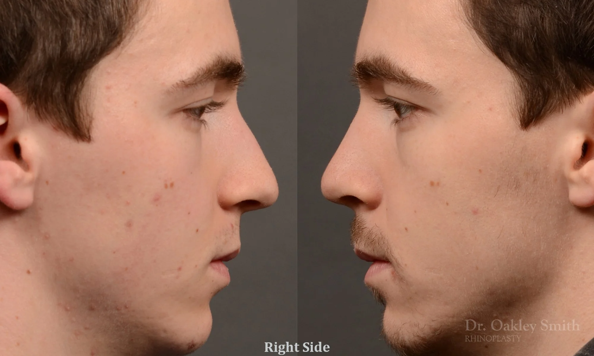 403: Primary Male Rhinoplasty, Normal Skin, Bridge Narrowing, Tip Work