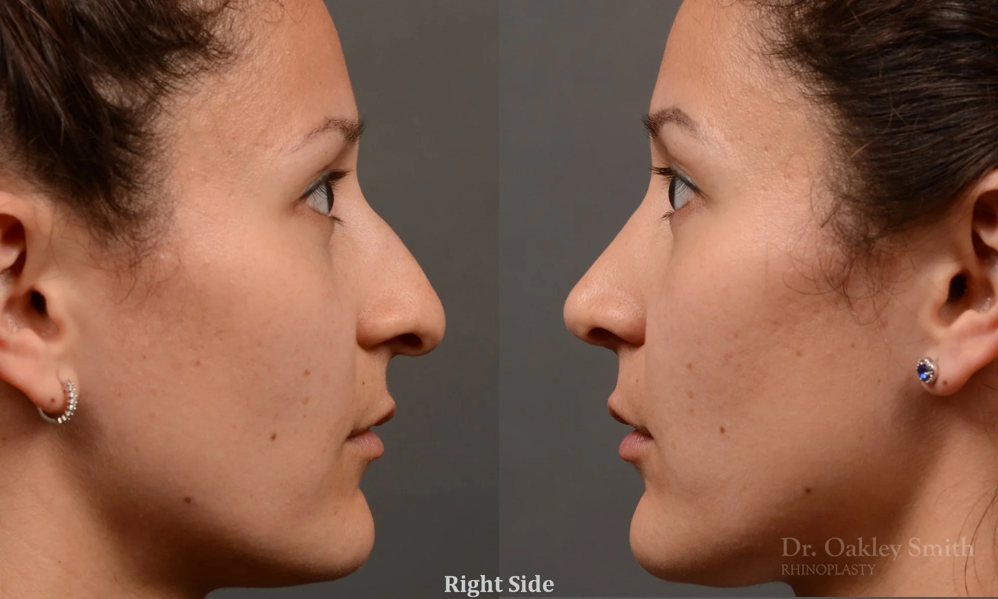 332C-rhinoplasty-dr-oakley-smith-toronto-nose-job (1).jpg