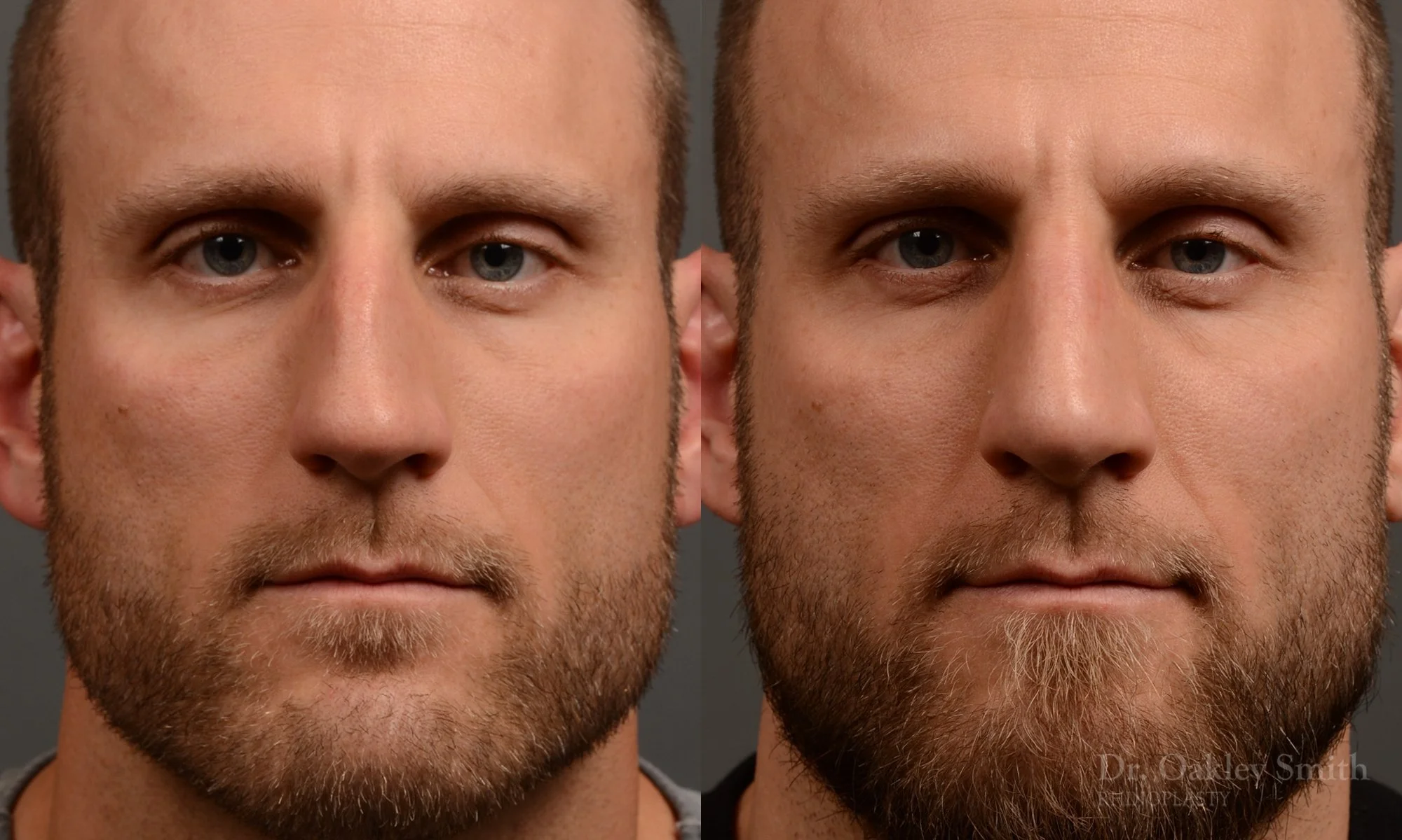 367.1A-rhinoplasty-dr-oakley-smith-toronto-male-nose-job.jpg