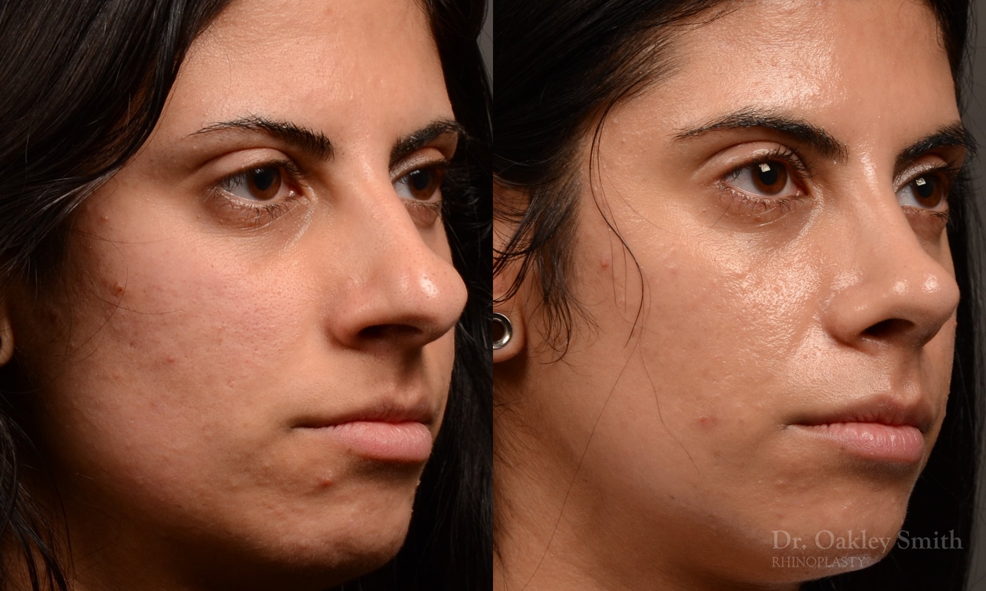 518B-rhinoplasty-dr-oakley-smith-toronto-top-surgeon-nose-job.jpg