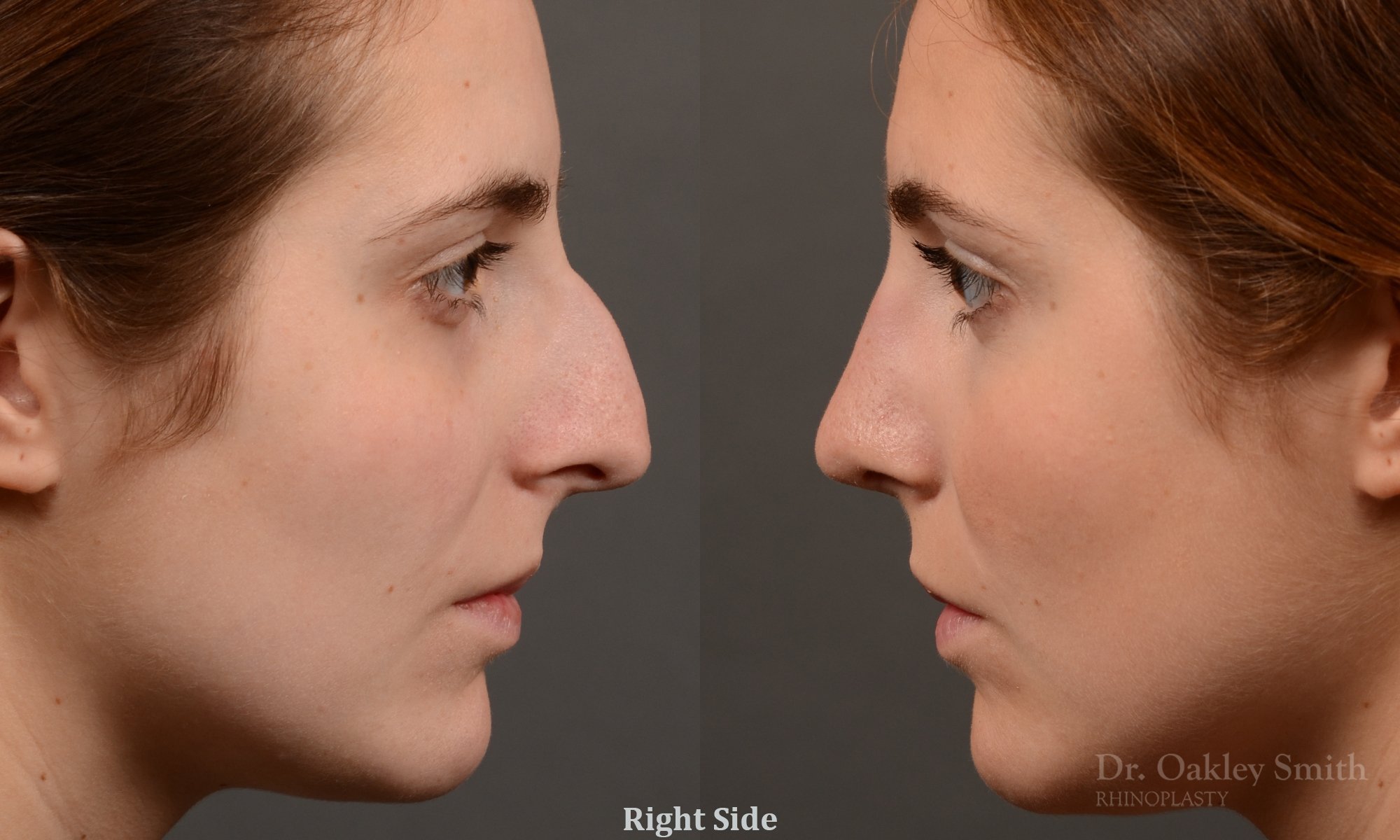305: Female, Ethnic Rhinoplasty, Thin Skin, Large Dorsal Hump, Tip Refinement