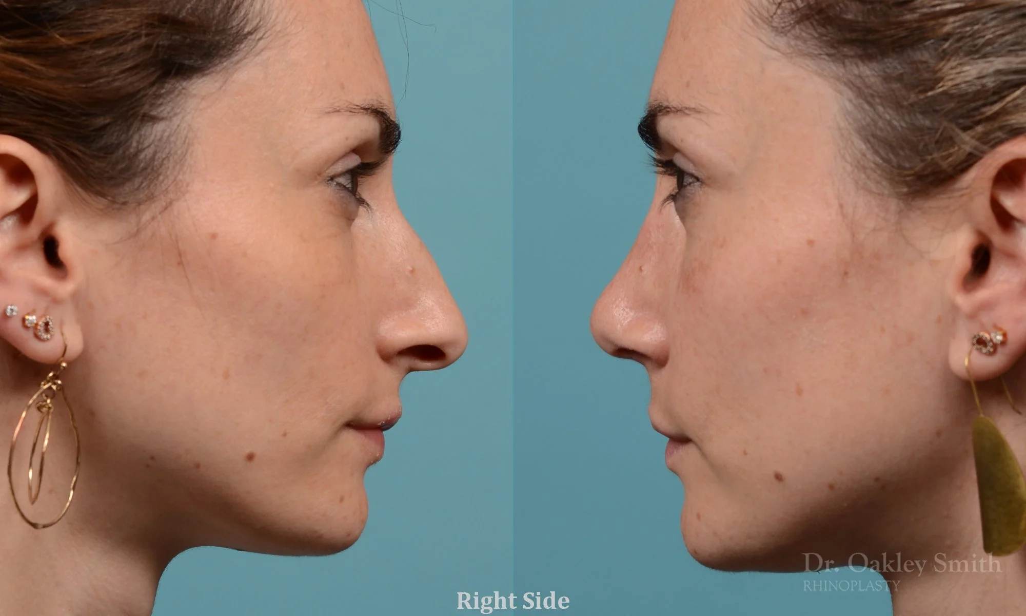 287: Female Rhinoplasty, Dorsal Hump, Droopy Tip Narrowing Refinement