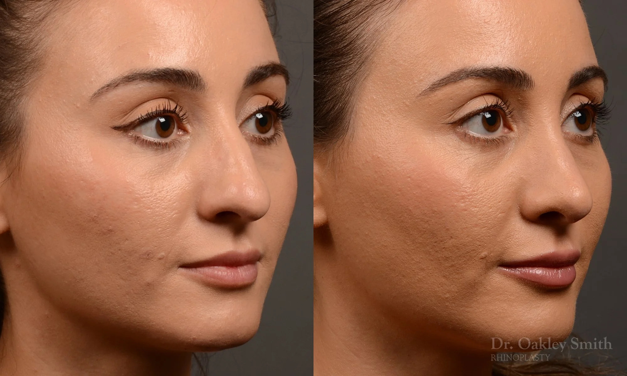 522B-rhinoplasty-dr-oakley-smith-toronto-top-surgeon-nose-job.jpg