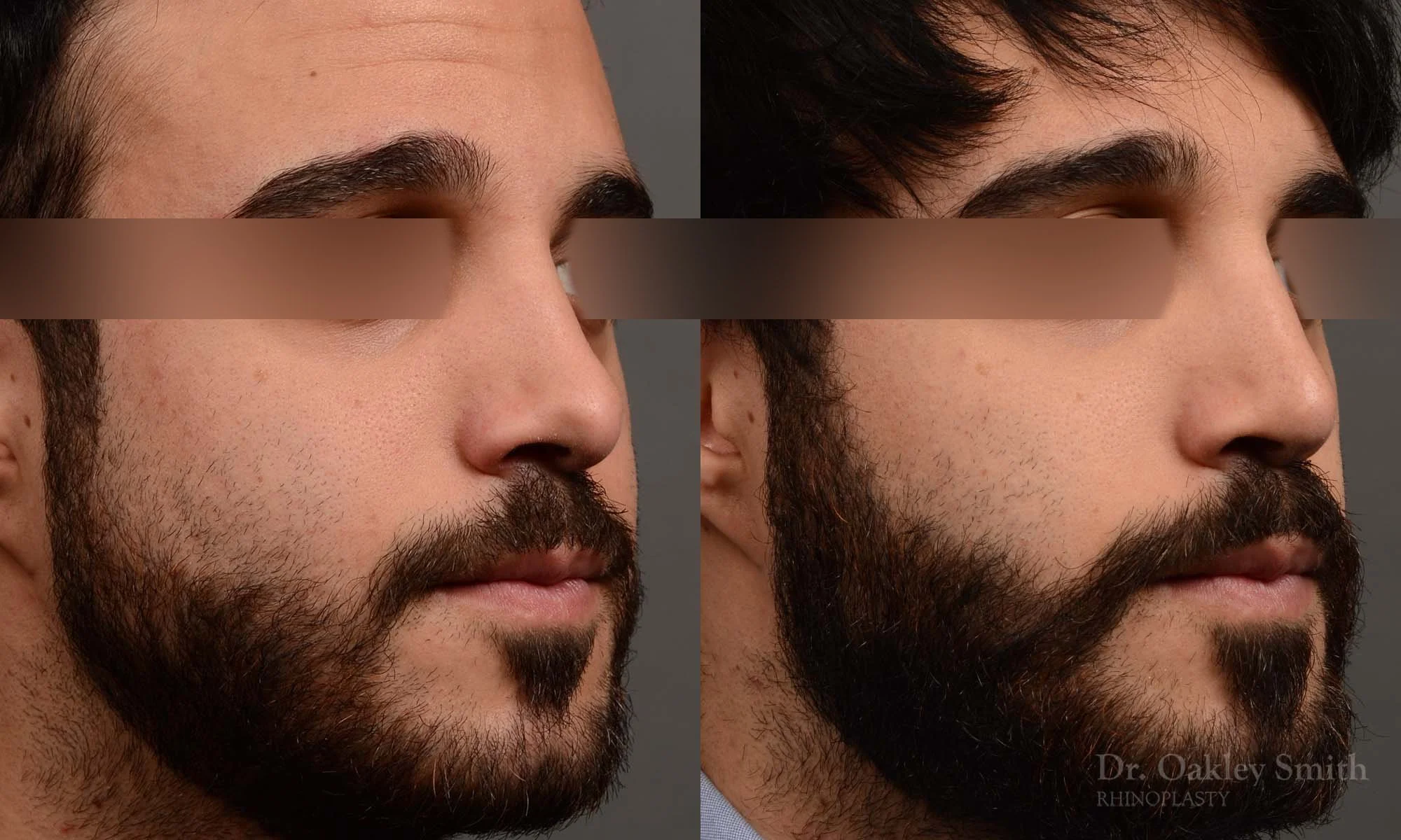 327.1B-rhinoplasty-dr-oakley-smith-toronto-nose-job.jpg