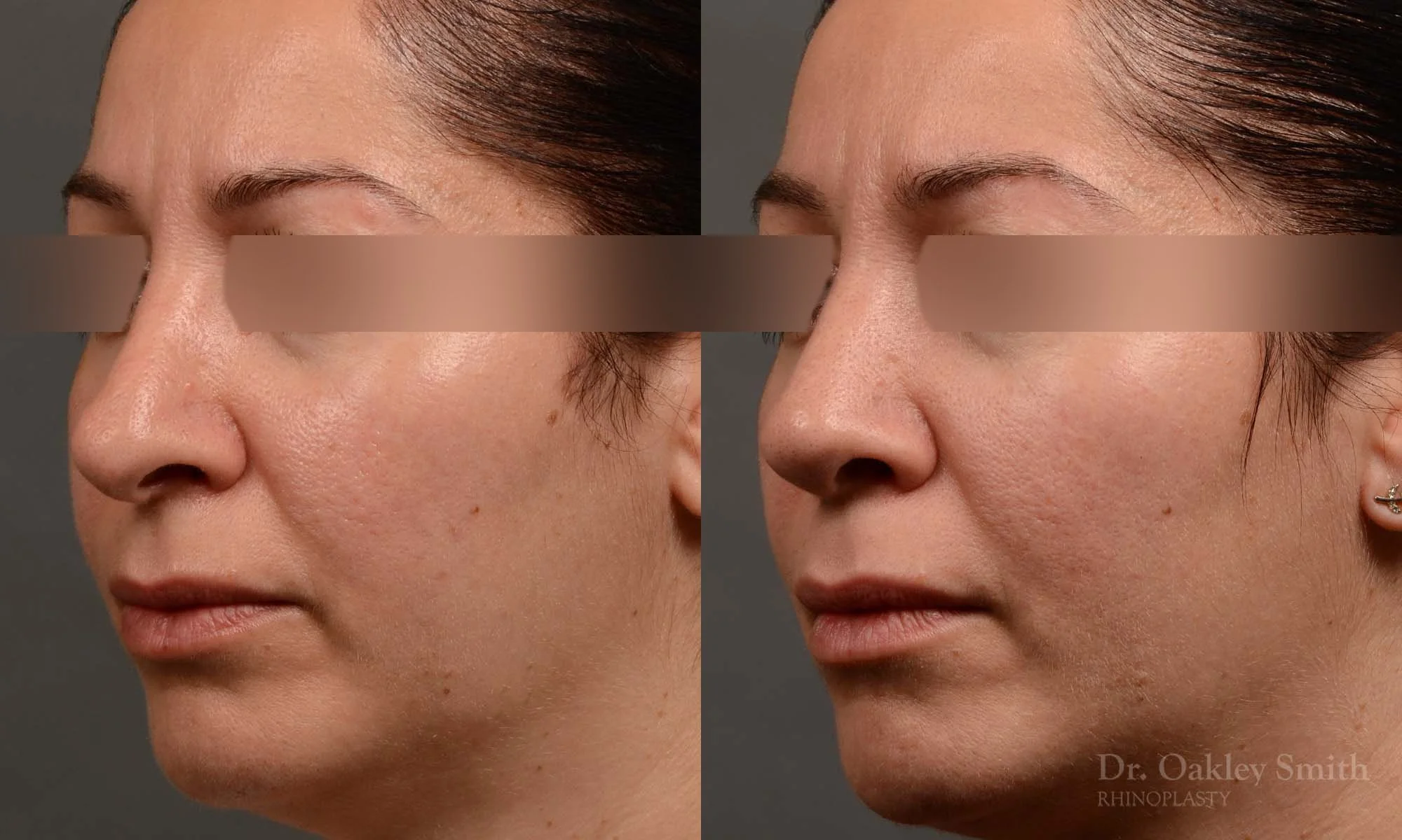 331D-rhinoplasty-dr-oakley-smith-toronto-nose-job.jpg