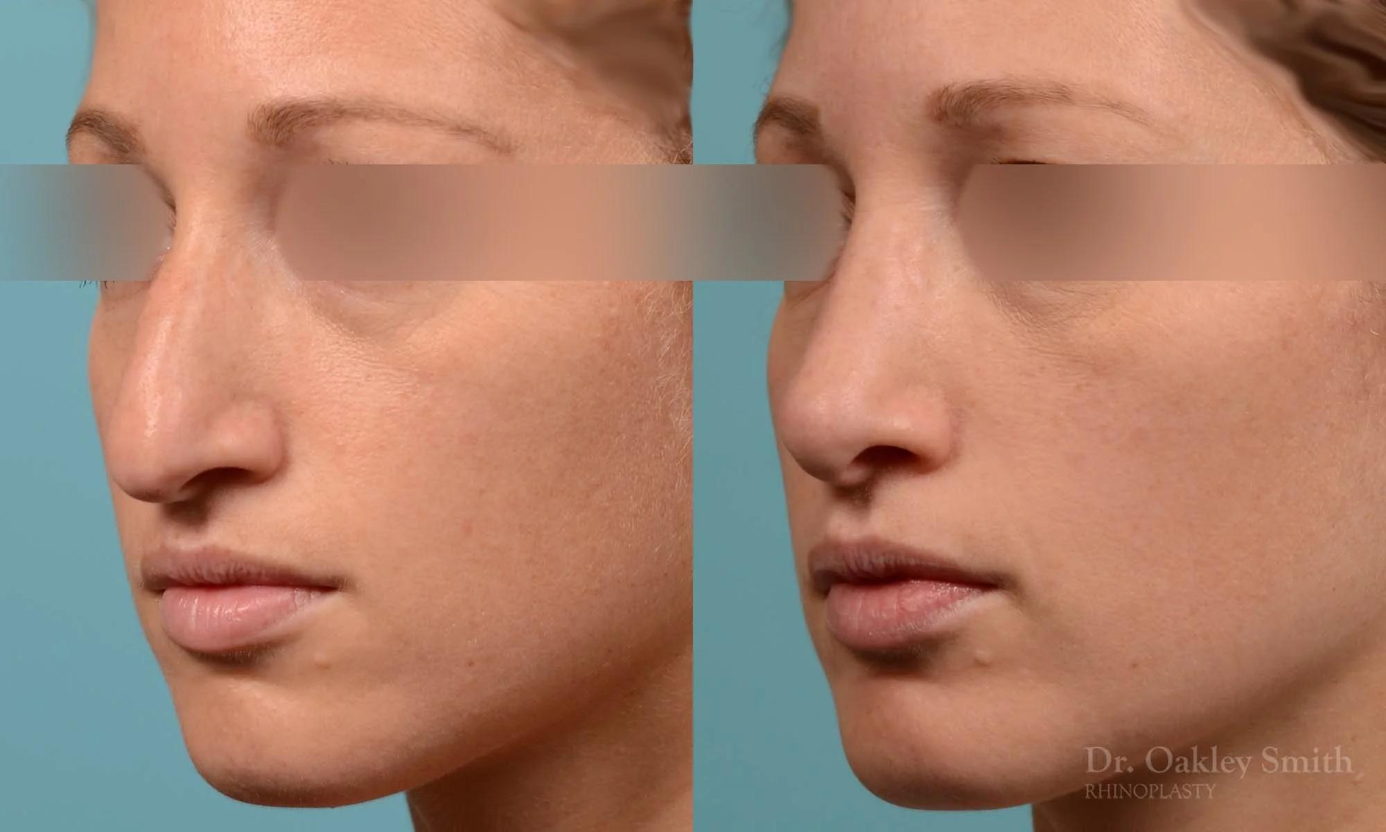 255D-rhinoplasty-dr-oakley-smith-toronto-female-nose-job.jpg
