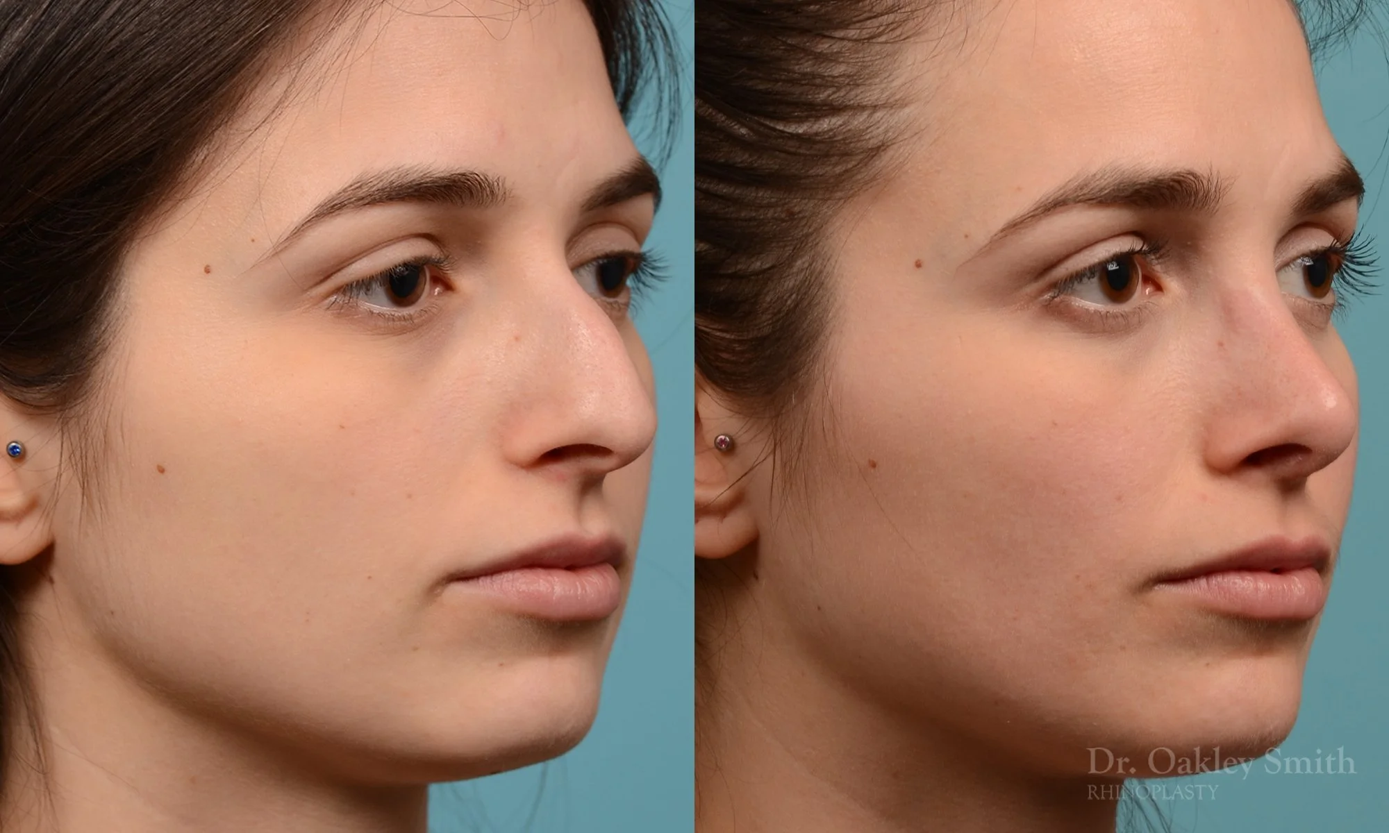 289B-rhinoplasty-dr-oakley-smith-toronto-nose-job.jpg