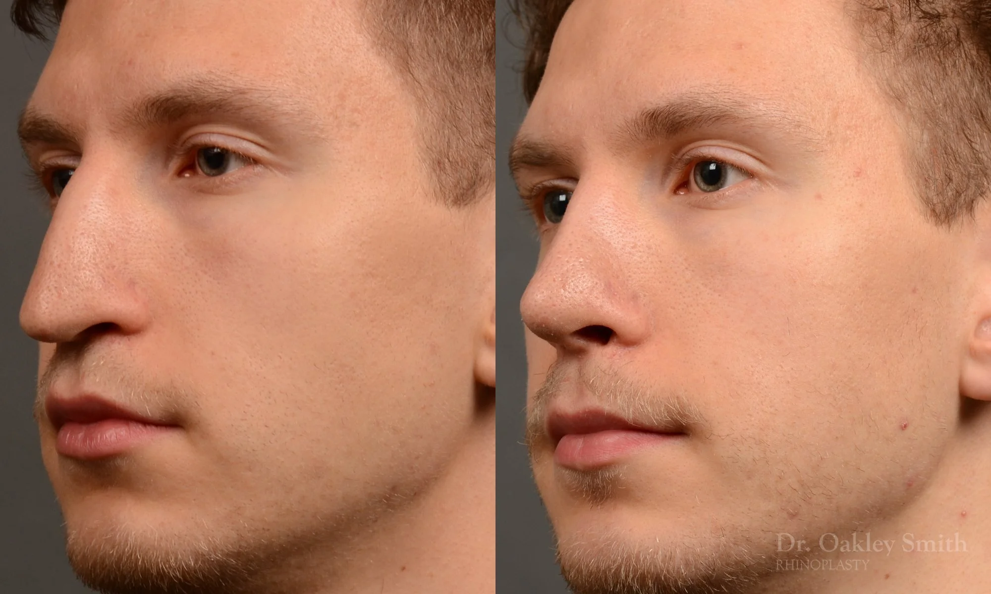 498D-rhinoplasty-dr-oakley-smith-toronto-top-surgeon-nose-job.jpg