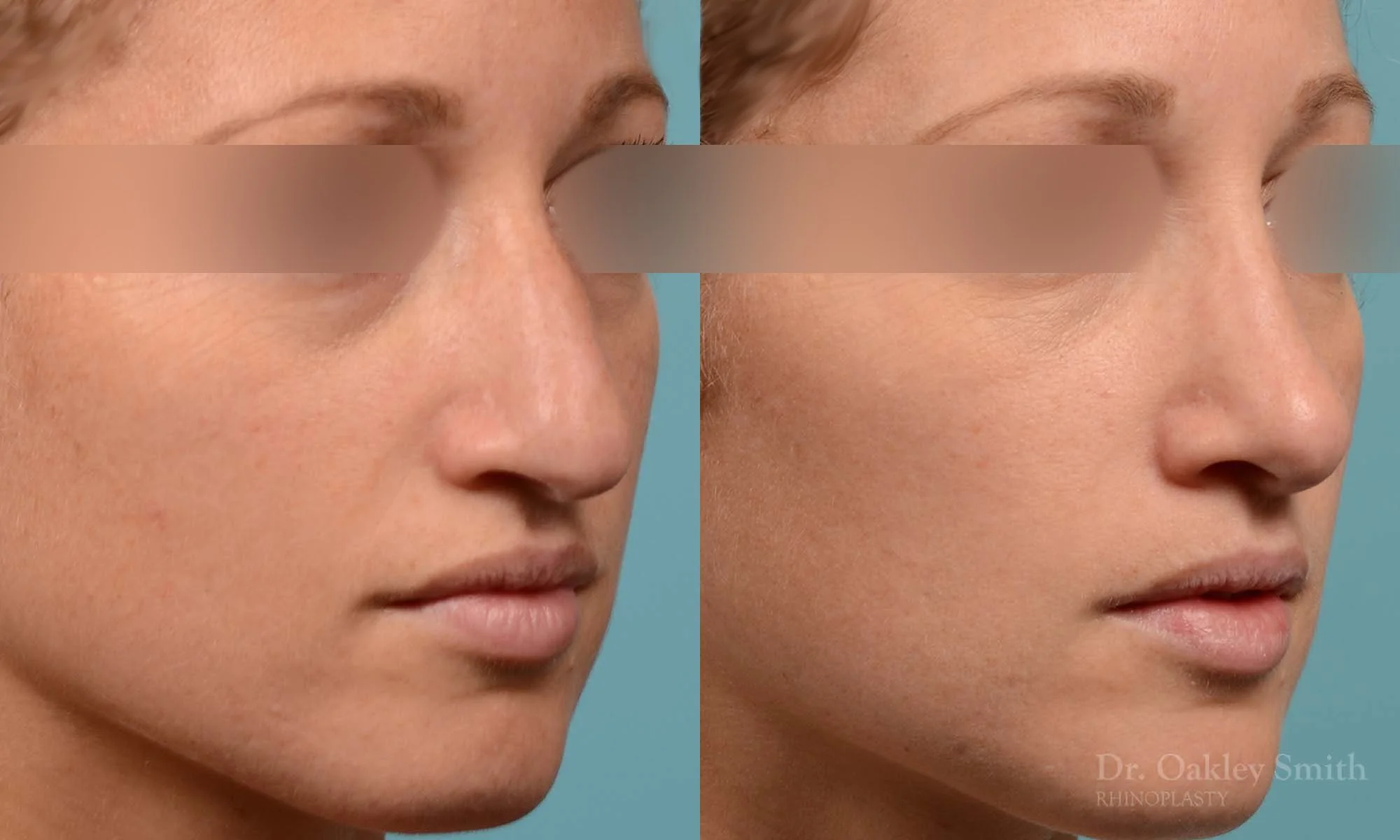 255B-rhinoplasty-dr-oakley-smith-toronto-female-nose-job.jpg
