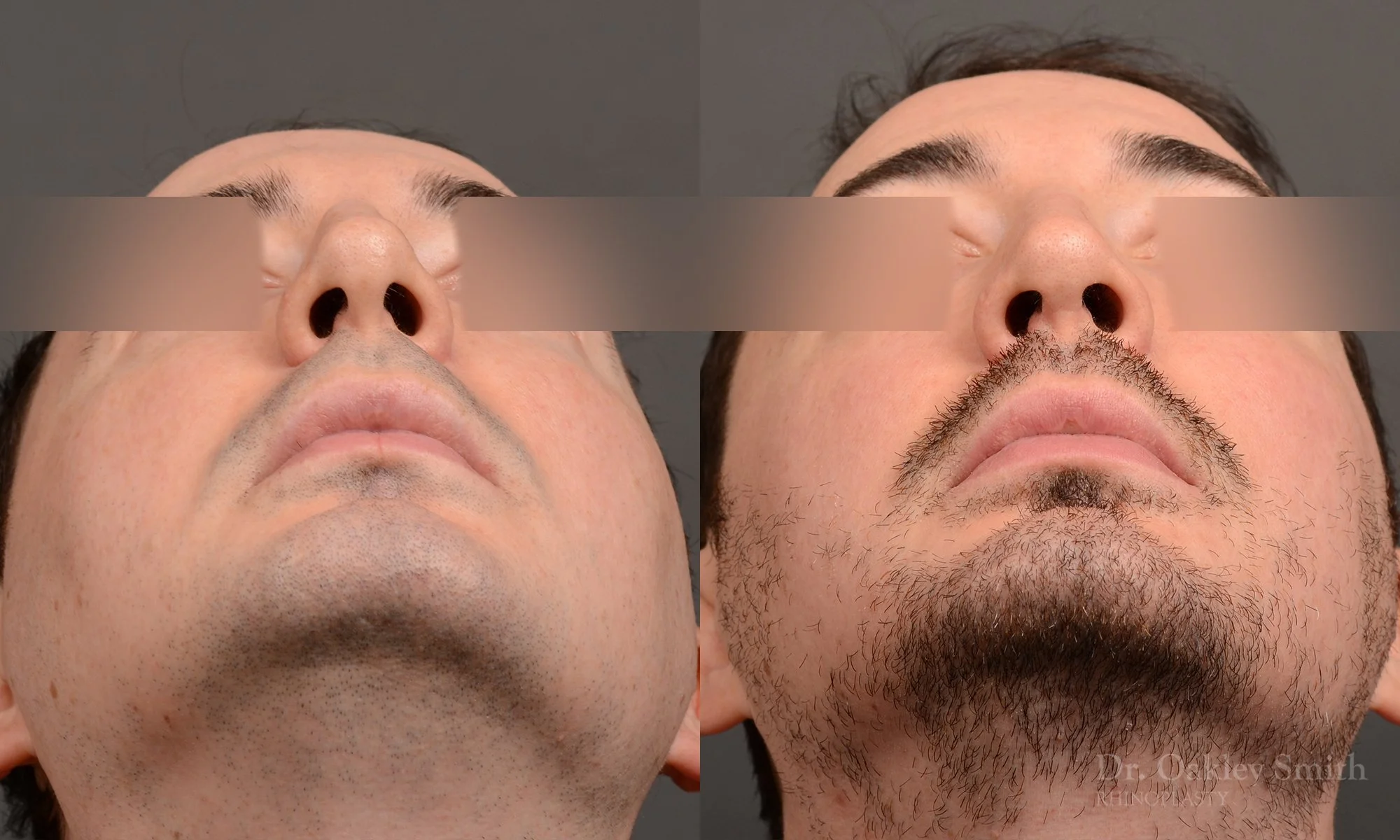 555F male rhinoplasty, nose job, toronto nose surgeon, dr oakley smith.jpg